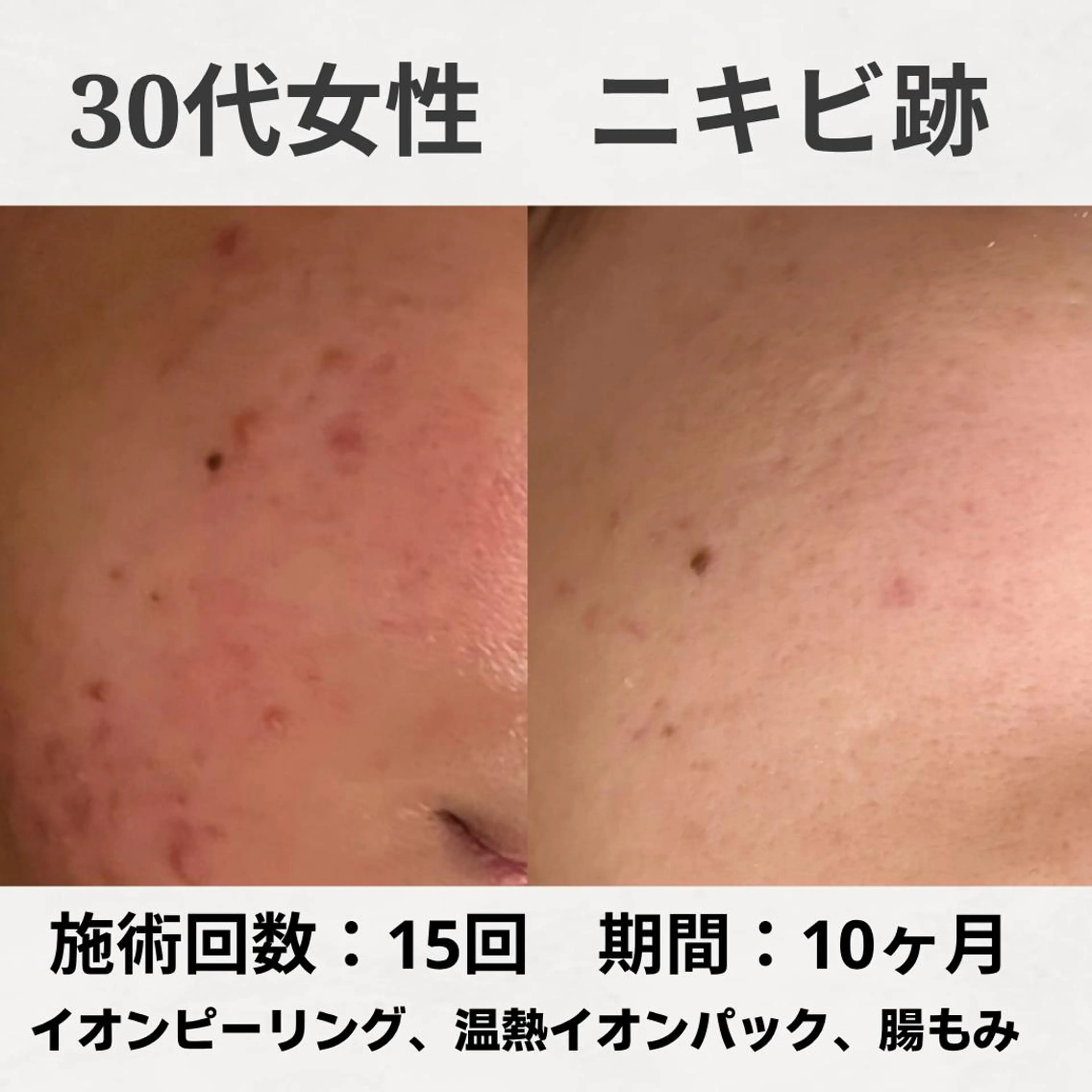 エステ リラク ニキビ跡改善専門🔥 医療にはできない改善のエステ・リラクイメージ