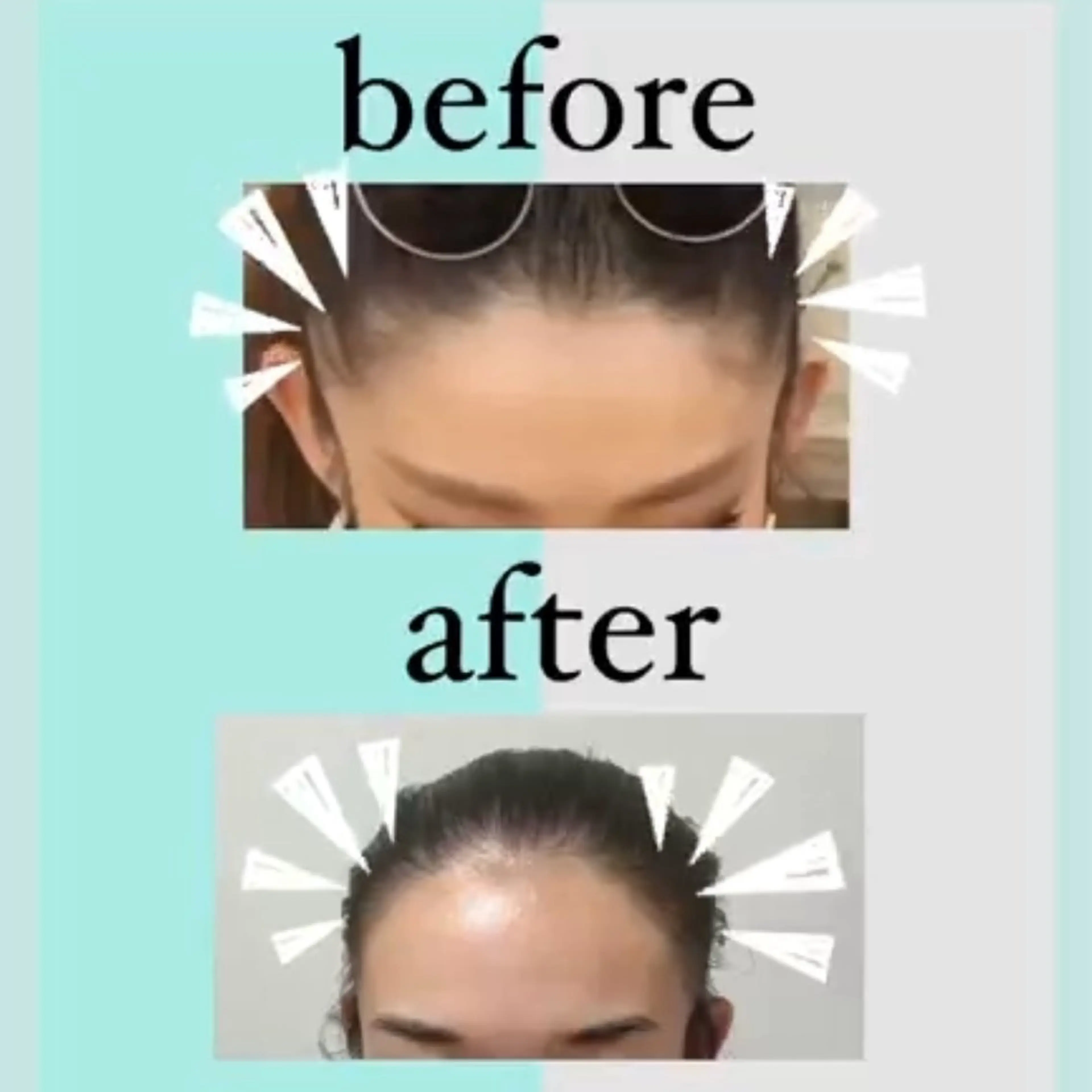 ⭐️ミニモ限定メニュー  VIO +顔の写真