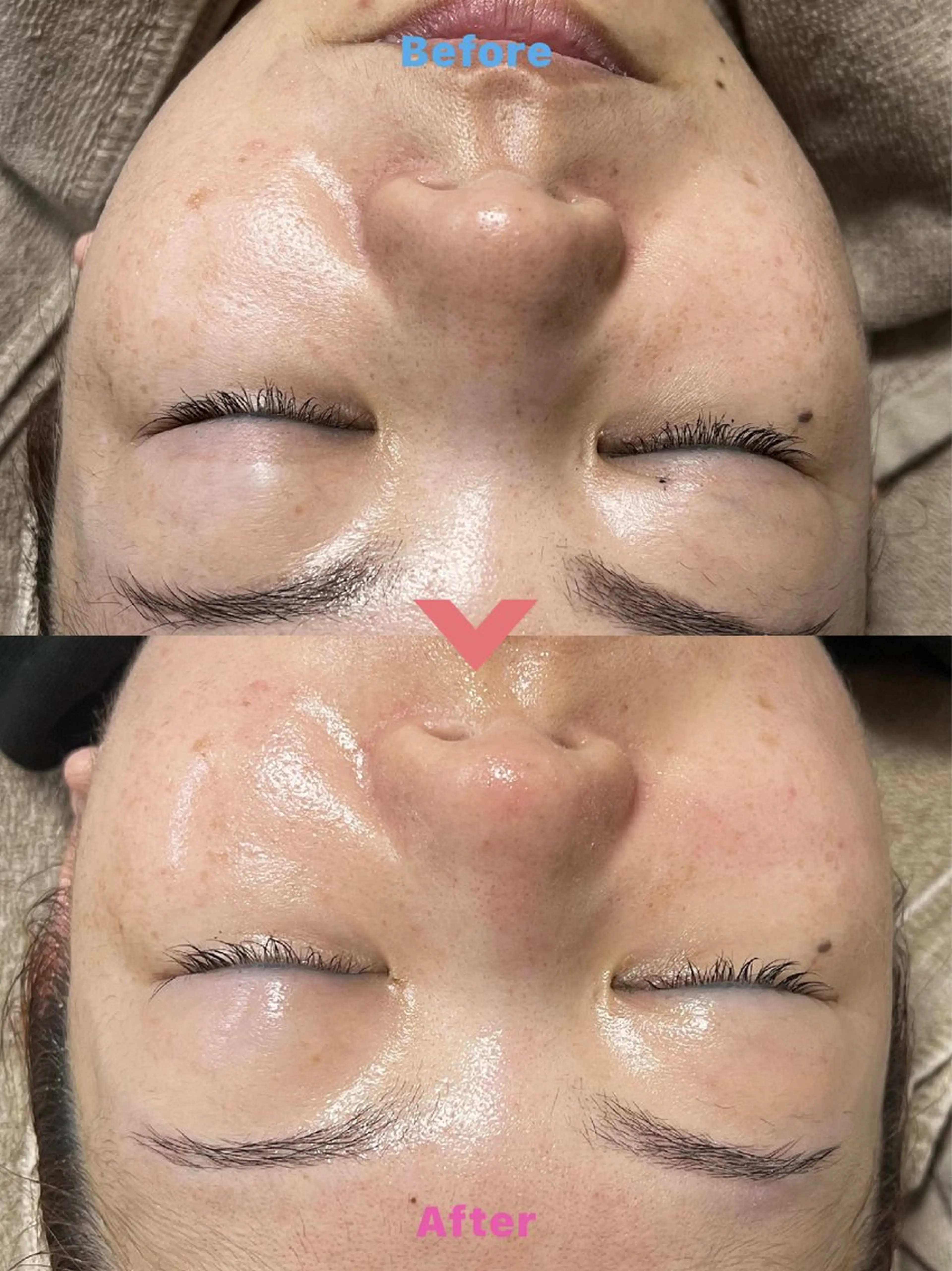 🌀毛穴洗浄🌀水素ピーリングで毛穴の黒ずみスッキリ👃✨の写真