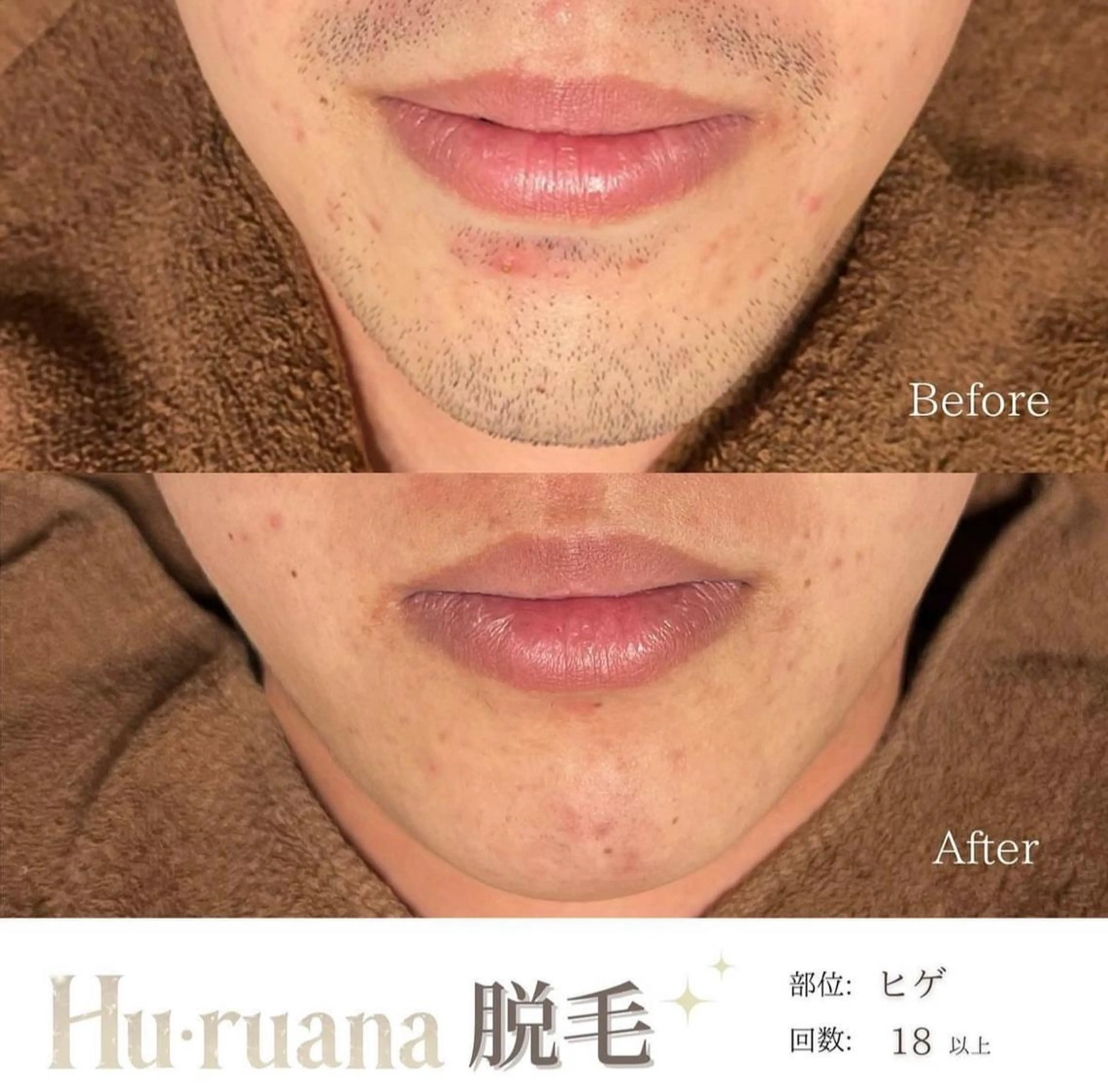 脱毛 Hu.ruana AWANOのエステ・リラクイメージ