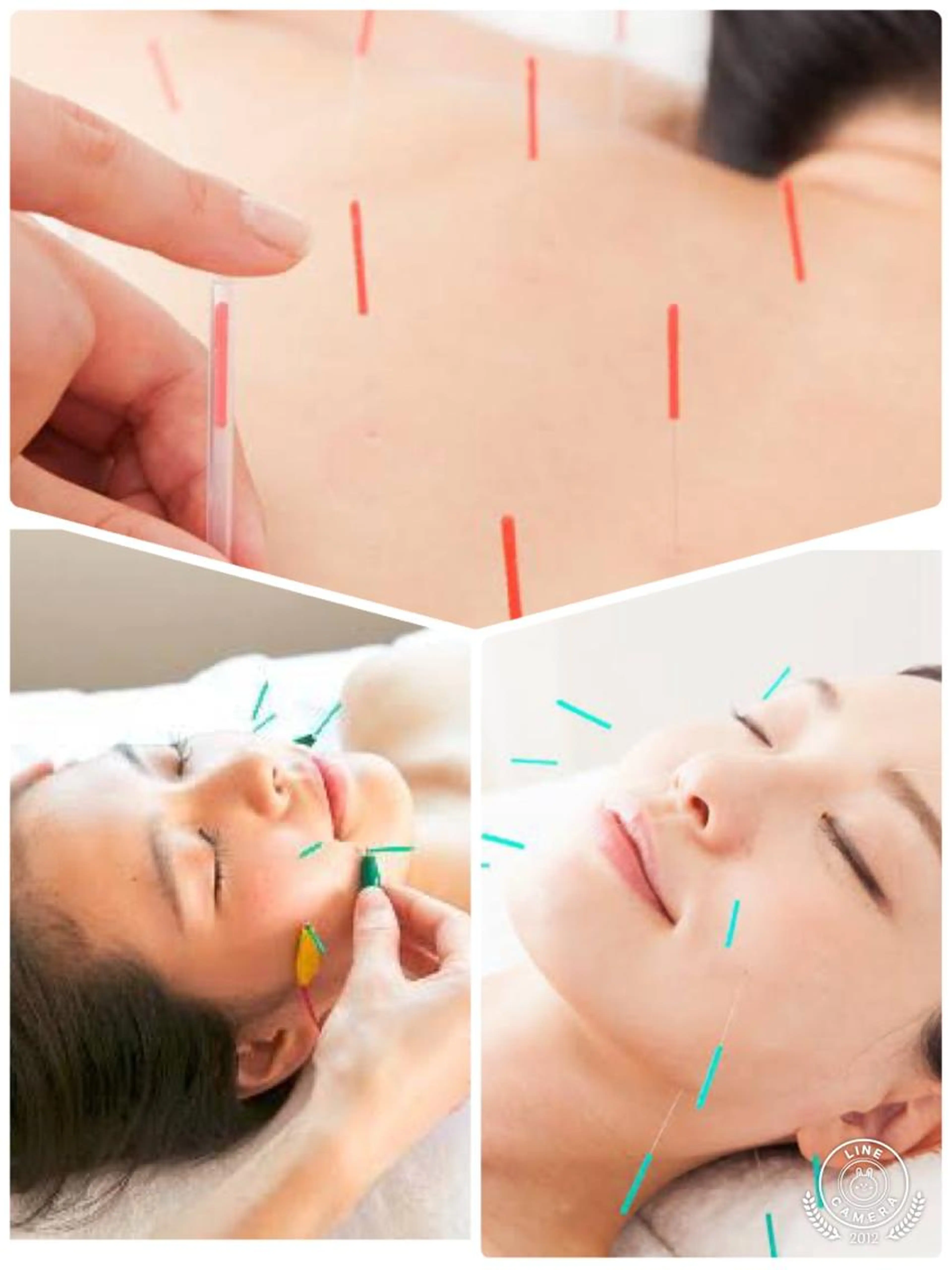 リピート率No.1🌟体質改善・美容鍼💙肌の悩みに合わせて体の鍼を施術、根本から改善したい方におすすめ✨の写真