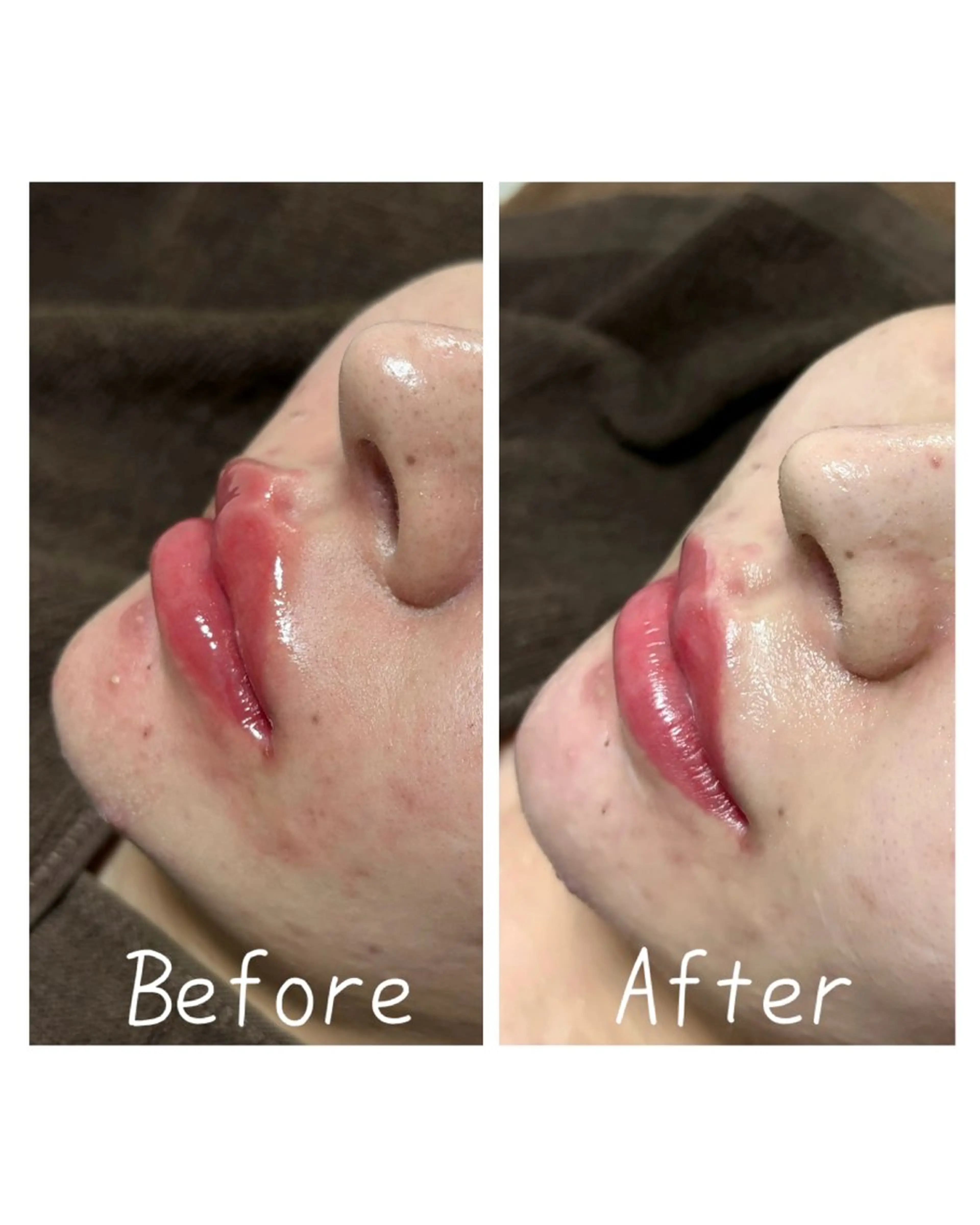 エステ ニキビ 毛穴ケア シャルム ココ みさのエステ・リラクイメージ