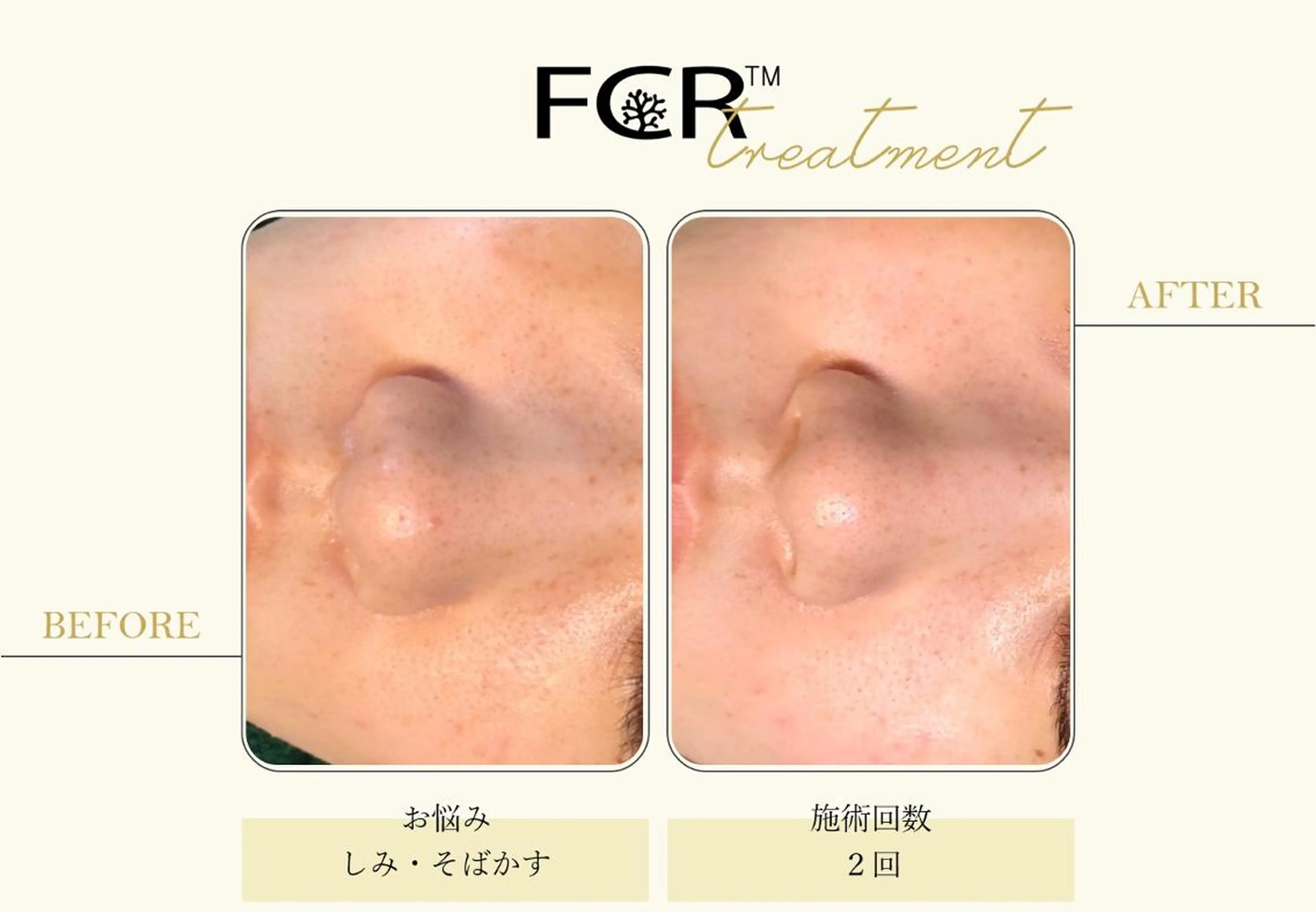 美容鍼灸/小顔鍼灸 肌質改善エステのエステ・リラクイメージ