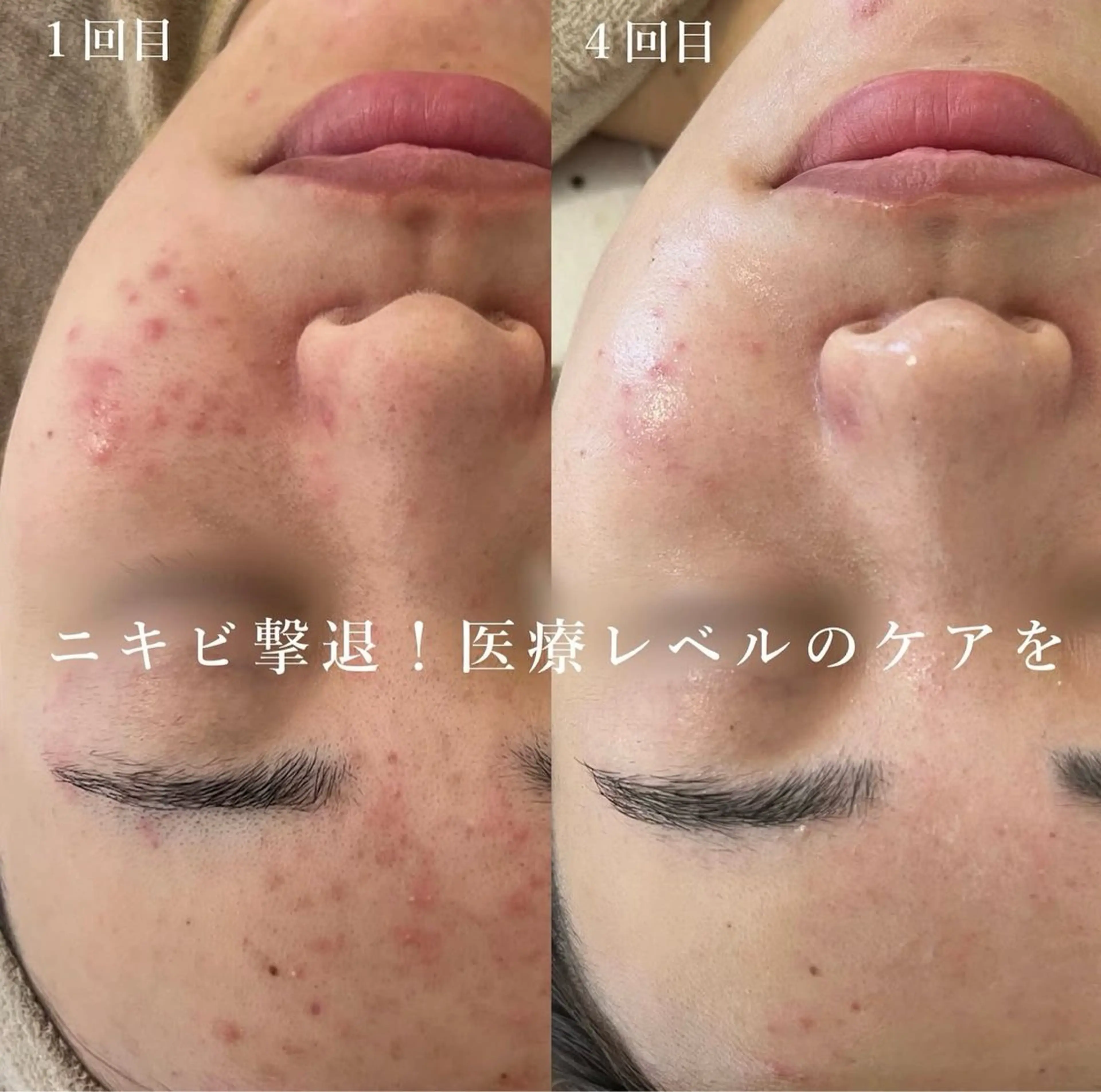 《しつこいニキビケア！細胞レベルで撃退！！》REVI陶肌トリートメント◎¥21,480→¥15,400の写真