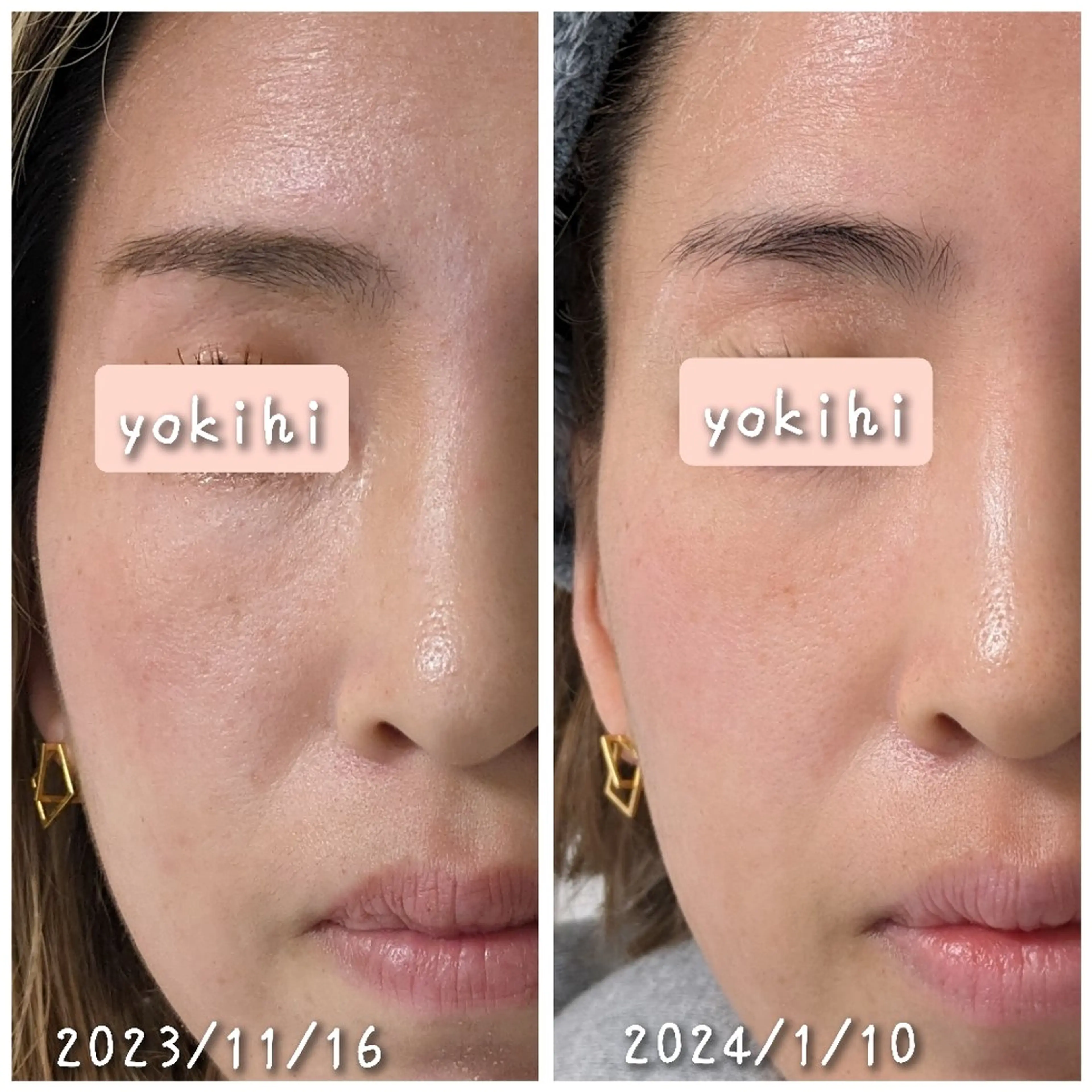 結果が出るスキンケア 肌質改善/まつパのエステ・リラクイメージ