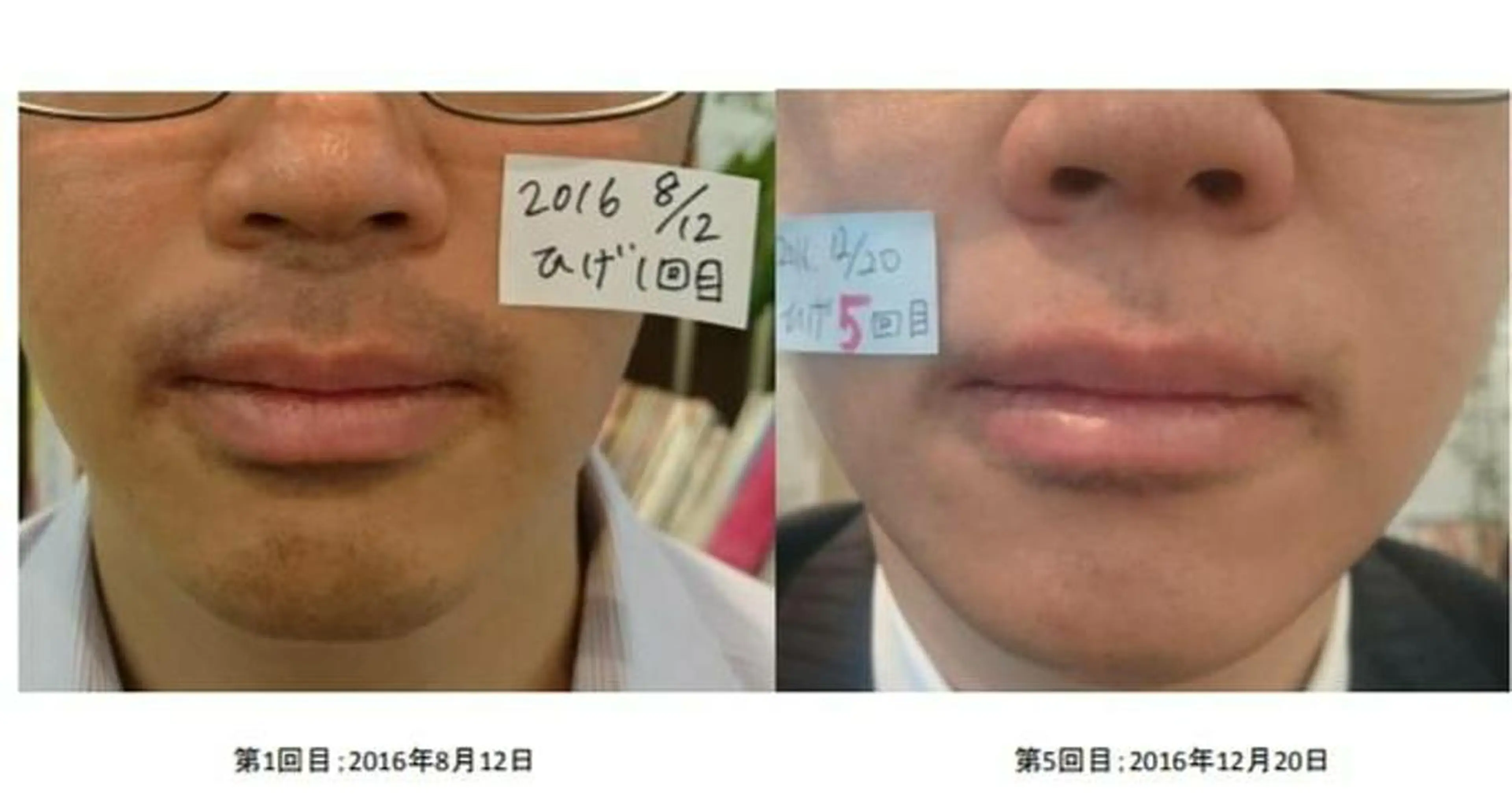 【初回★minimo男性限定】痛くない！メンズヒゲ脱毛（口周り）の写真