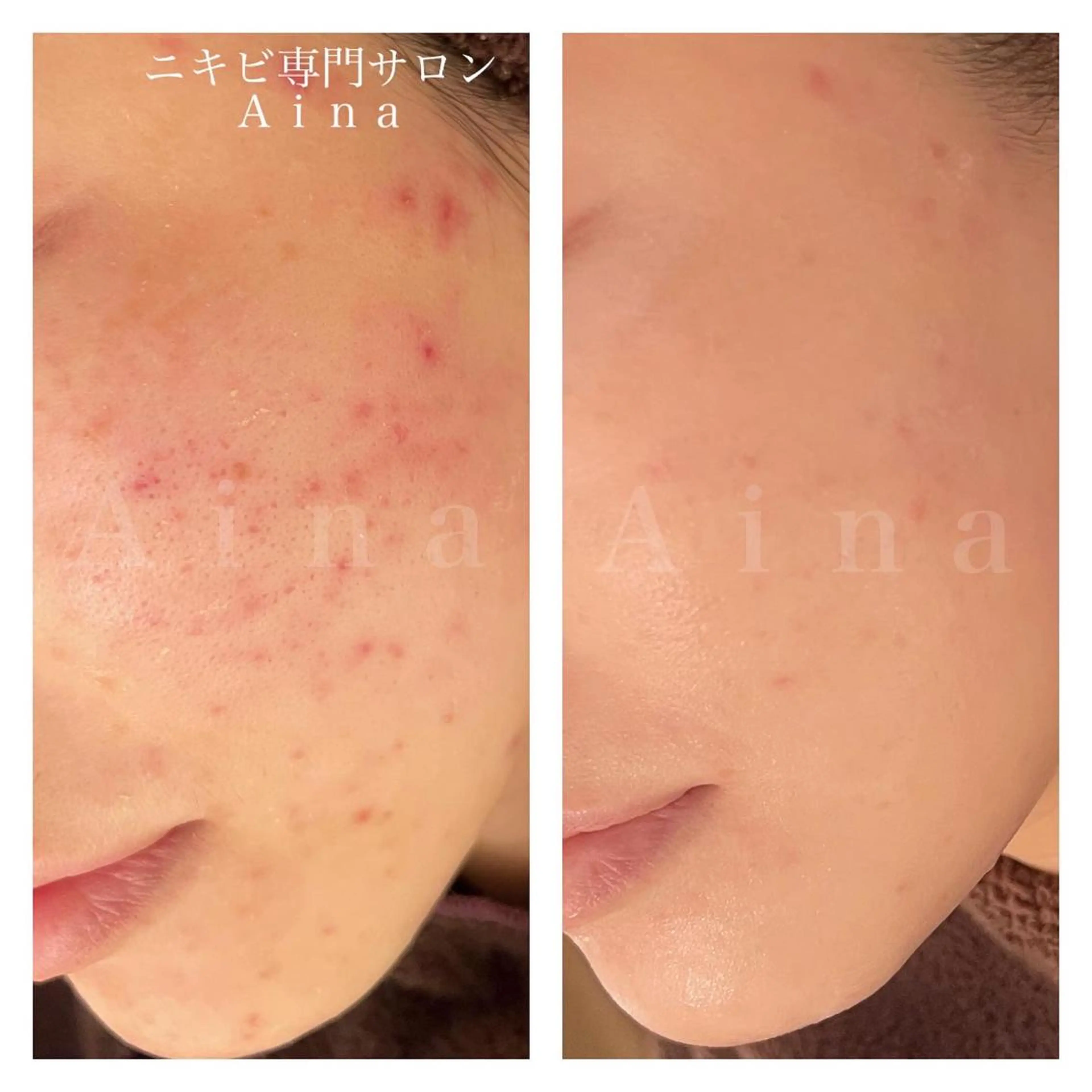 セミロング パーマ ヘアアレンジ メンズ キッズ ネイル マツエク・マツパ アイブロウ ニキビ跡専門サロン Ａｉｎａのエステ・リラクイメージ