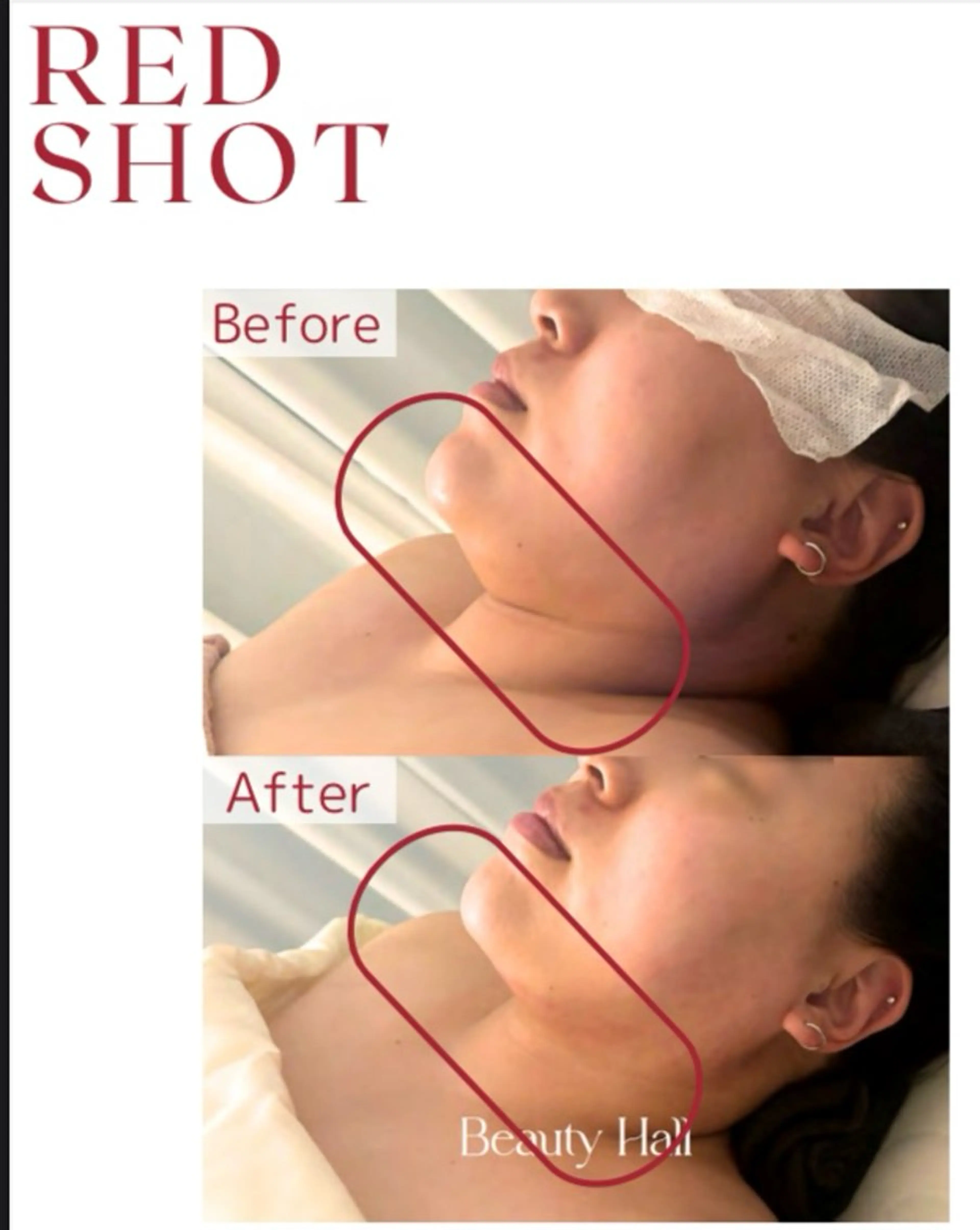 【韓国肌管理】REDSHOT導入フェイシャル【顔全体】の写真