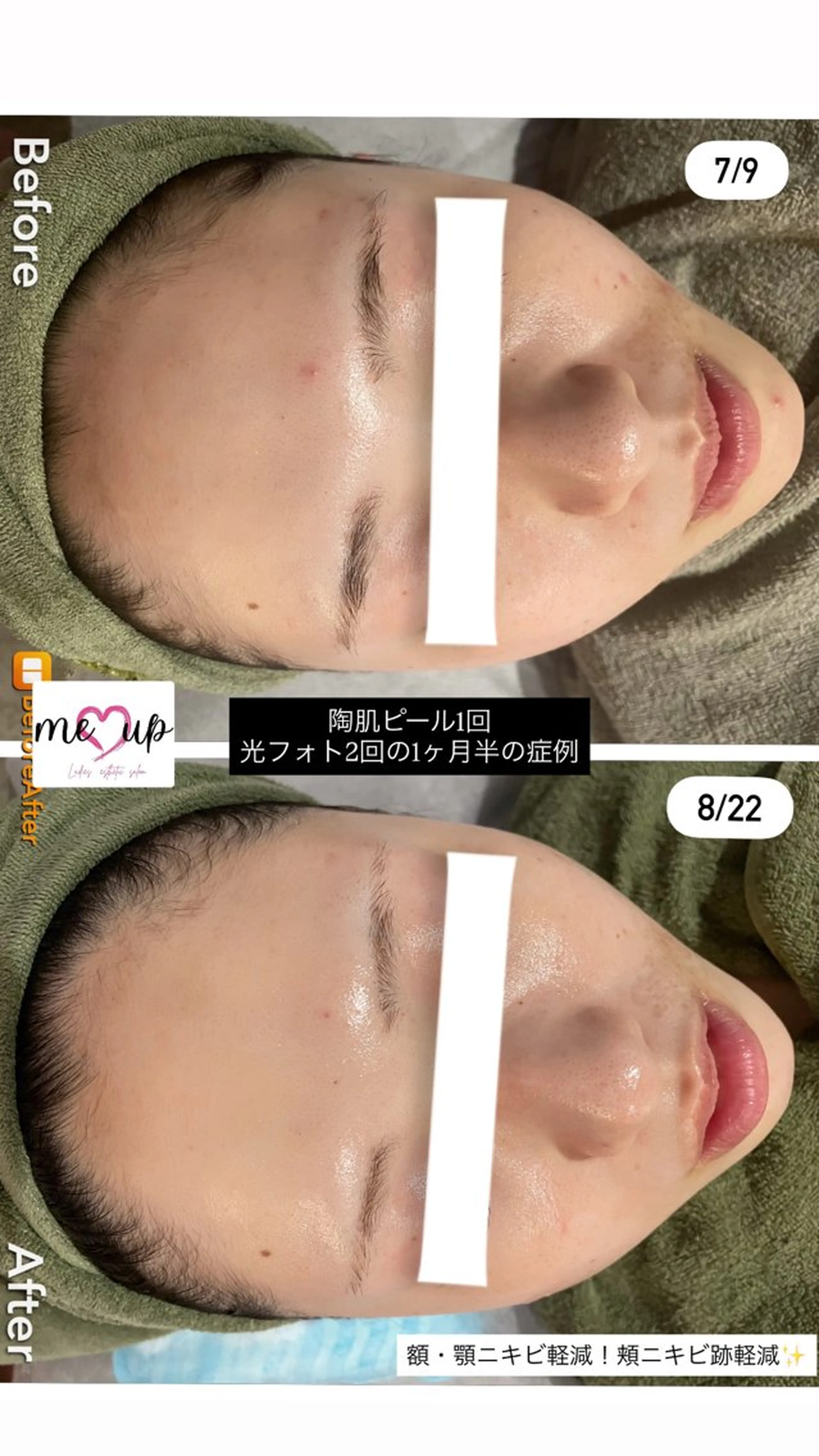 エステ Meupニキビ専門店 背中/ハーブ/肌管理のその他イメージ