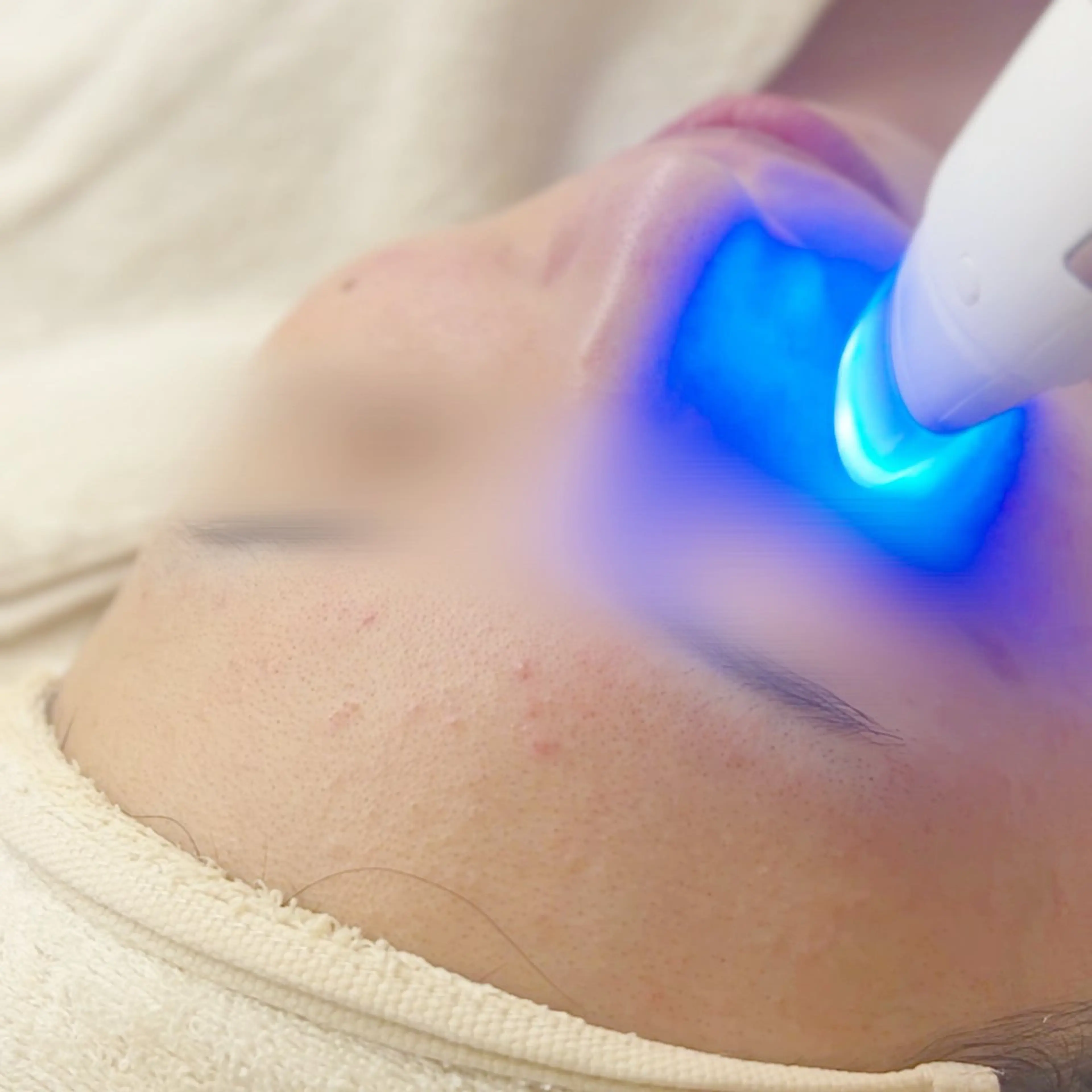 【輝く白玉水光肌へ】乳酸ピーリング/プラズマフェイシャルの写真