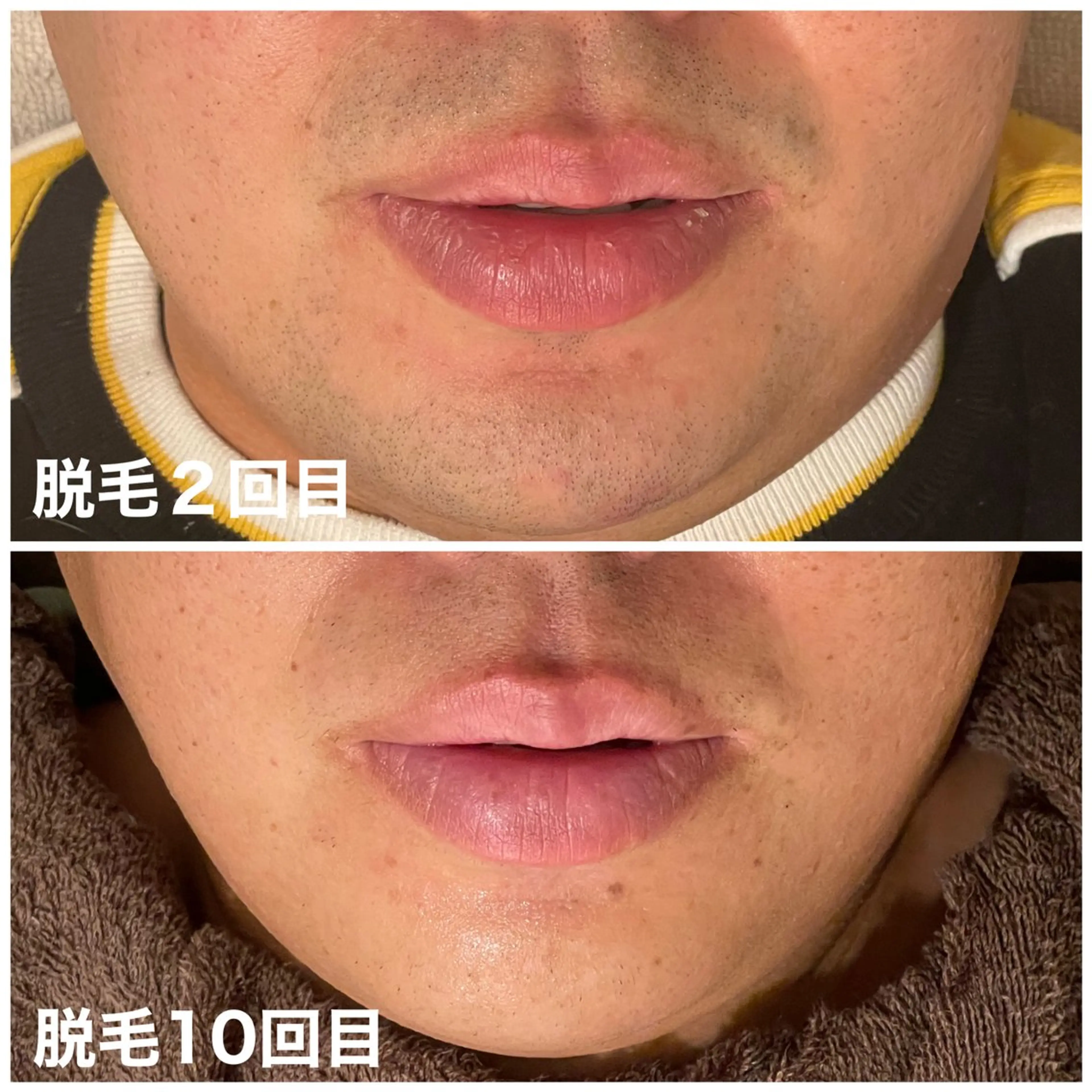 【メンズ】ヒゲ脱毛1パーツ体験の写真
