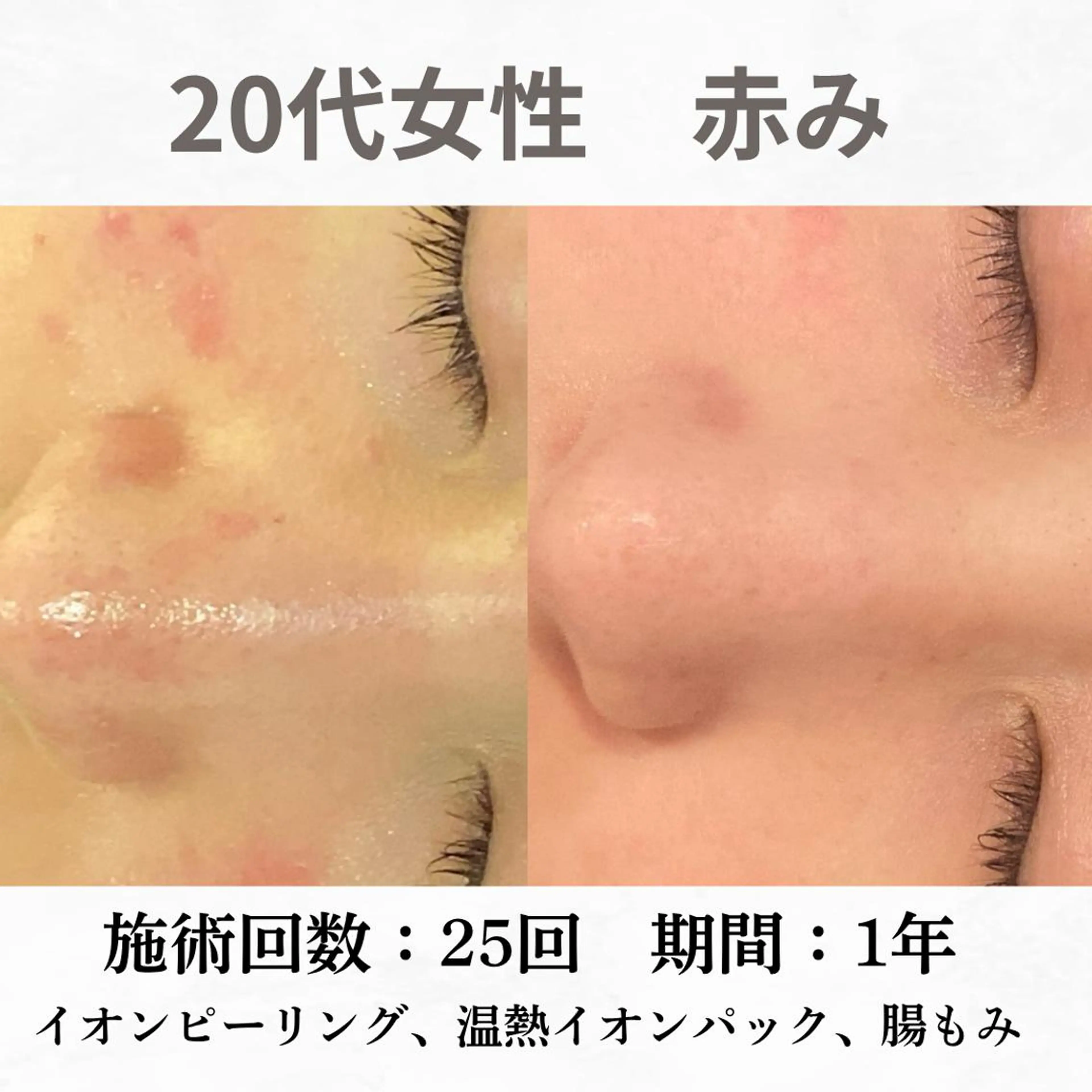 重度ニキビ専門🌷 ダウンタイムなしのエステ・リラクイメージ