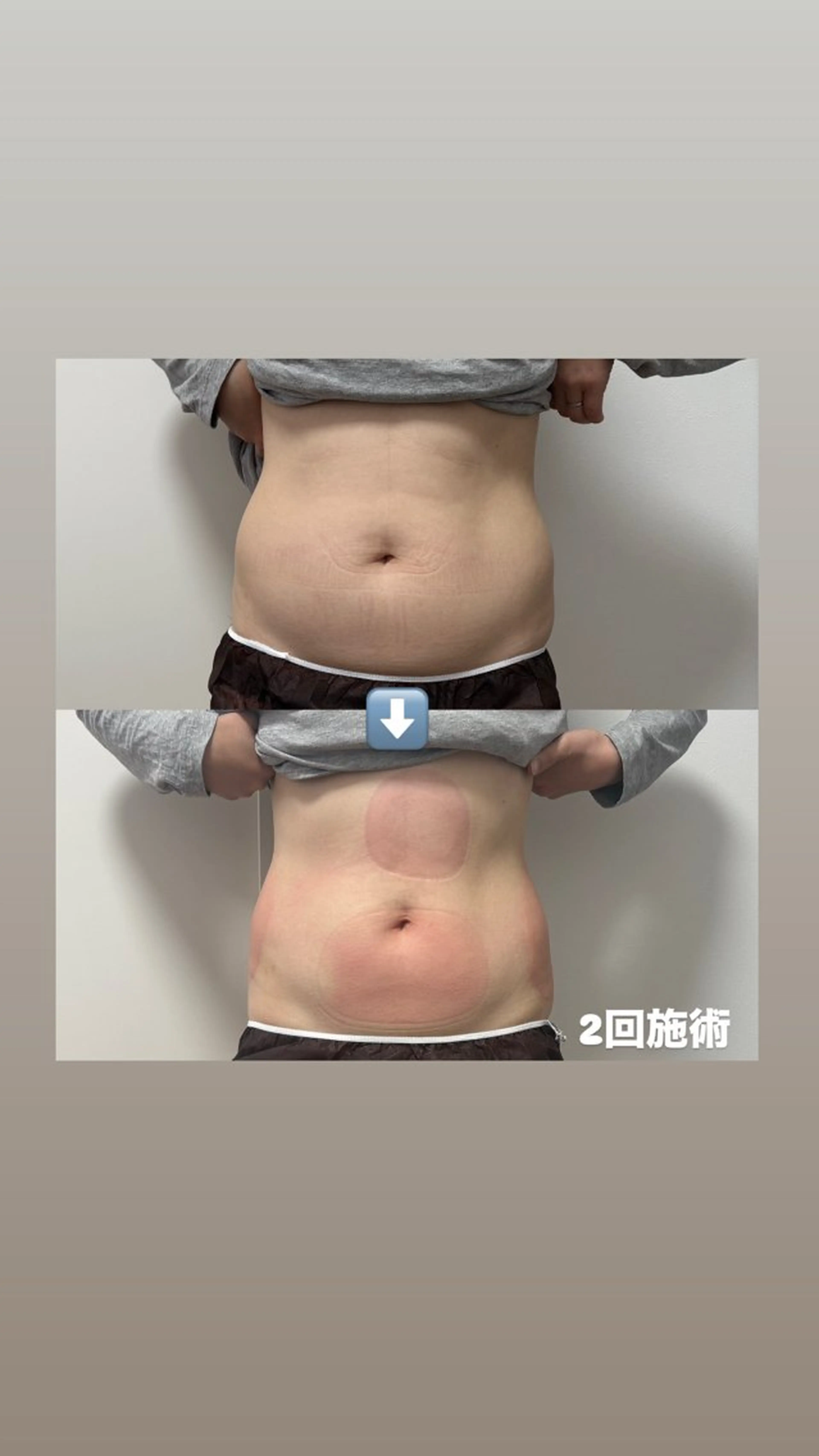 再来❄️冷却痩身4カップ🧊お好きな箇所どこでも⭕️(早く痩せたい方におすすめ)の写真