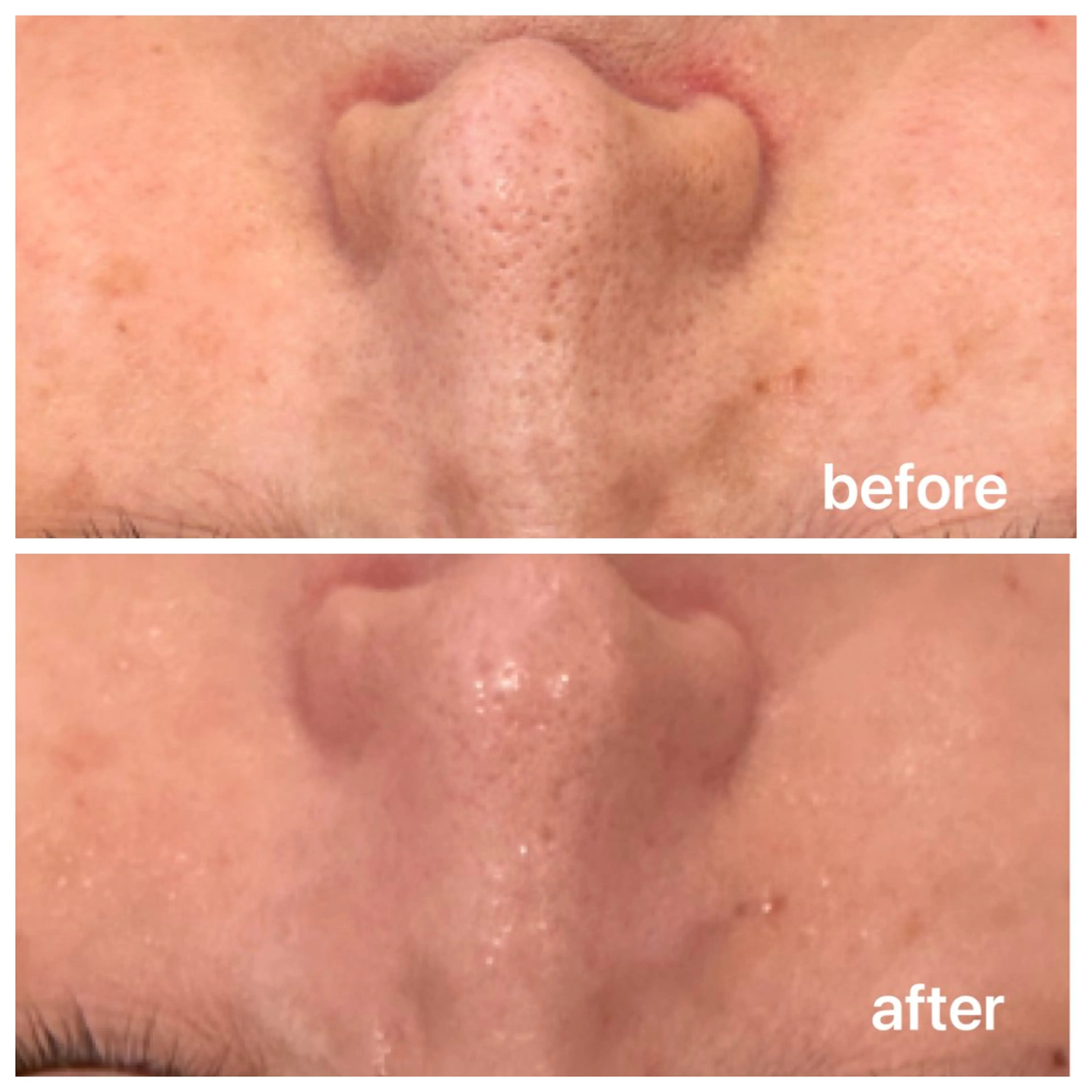 ⭐️ミニモ限定⭐️毛穴洗浄・ハイドラフェイシャルコース60分の写真