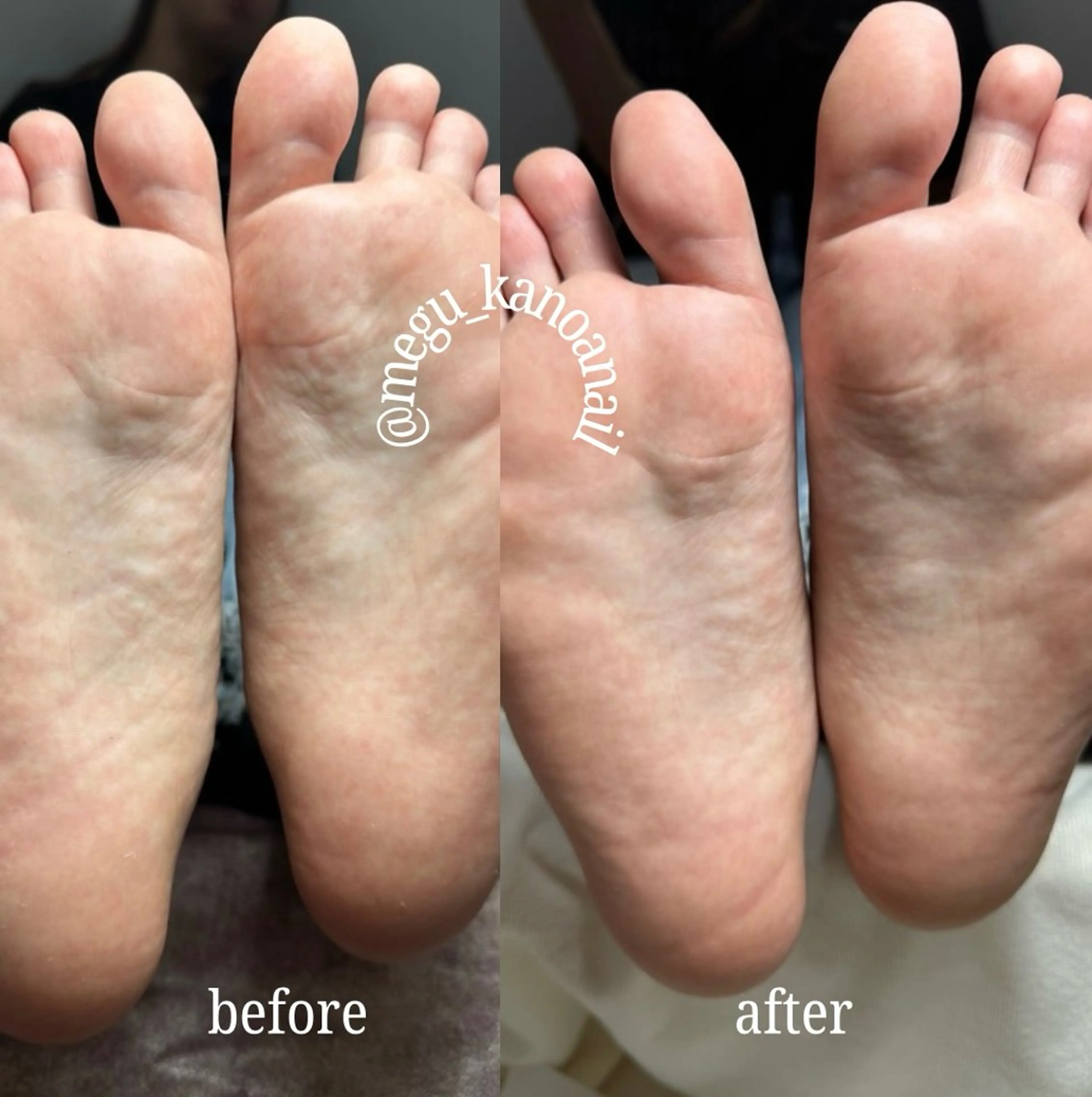 フット角質ケア🦶🌿（角質ケア、フットバス付）の写真