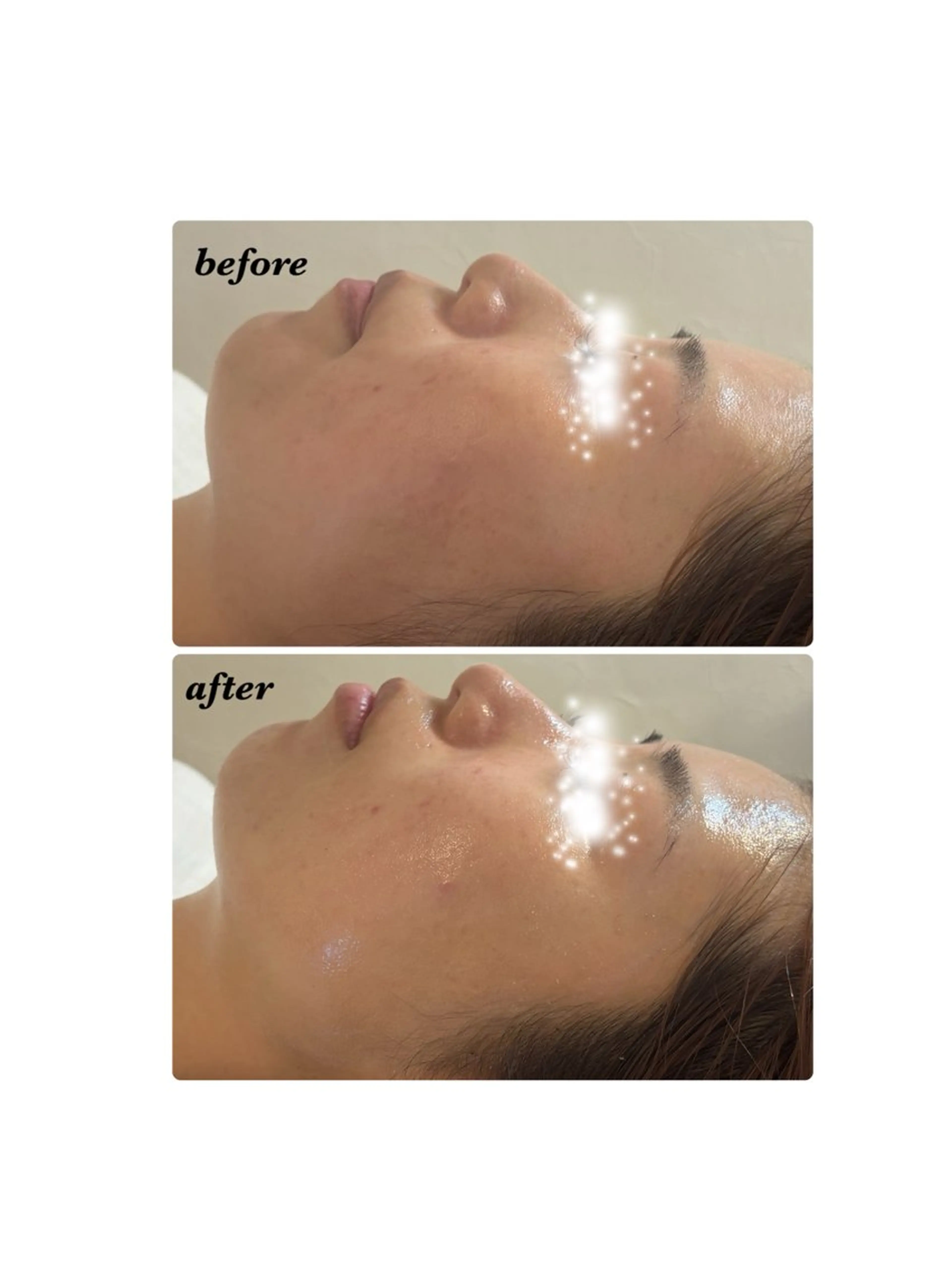 メンズ ハーブピーリング/韓国肌管理/フェイシャル/毛穴洗浄/眉毛/顔脱毛【糸脱毛専門】rev所属・ハーブピーリング専門 毛穴洗浄❤️眉waxのエステ・リラクイメージ