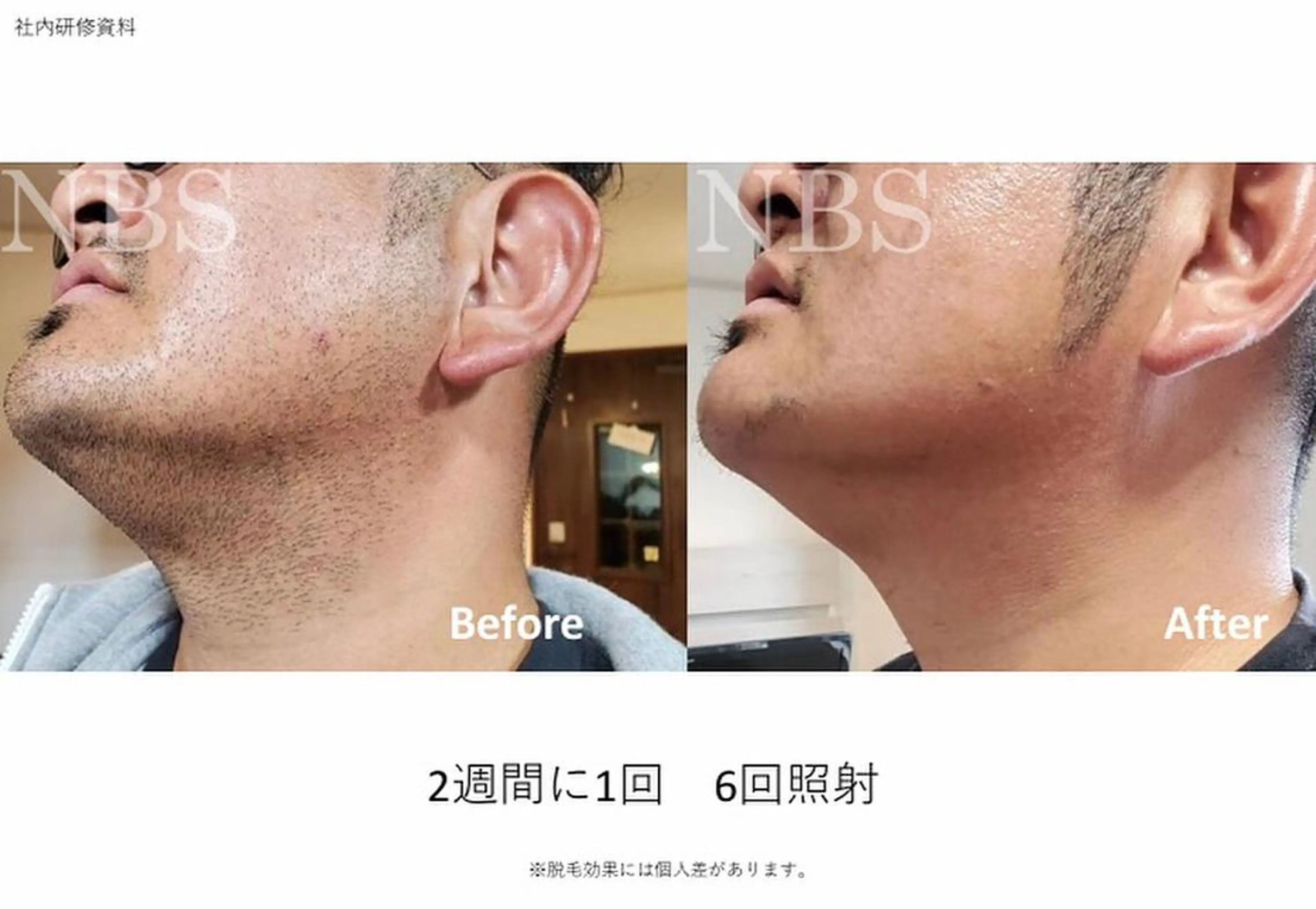 男性限定◎ ヒゲ全体 脱毛（あご・鼻下・頬・頬下の首・あご下の首）の写真