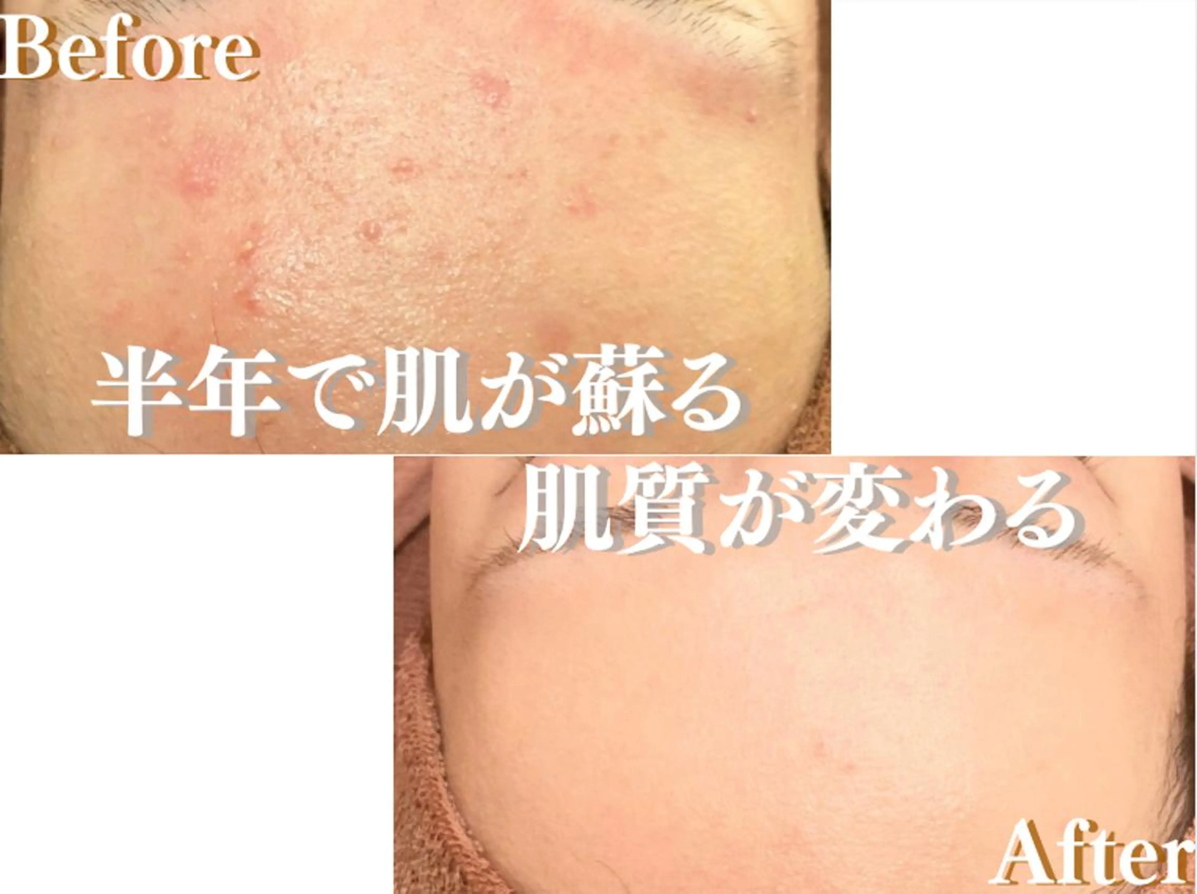 エステ リラク ニキビ跡改善専門🔥 医療にはできない改善のエステ・リラクイメージ