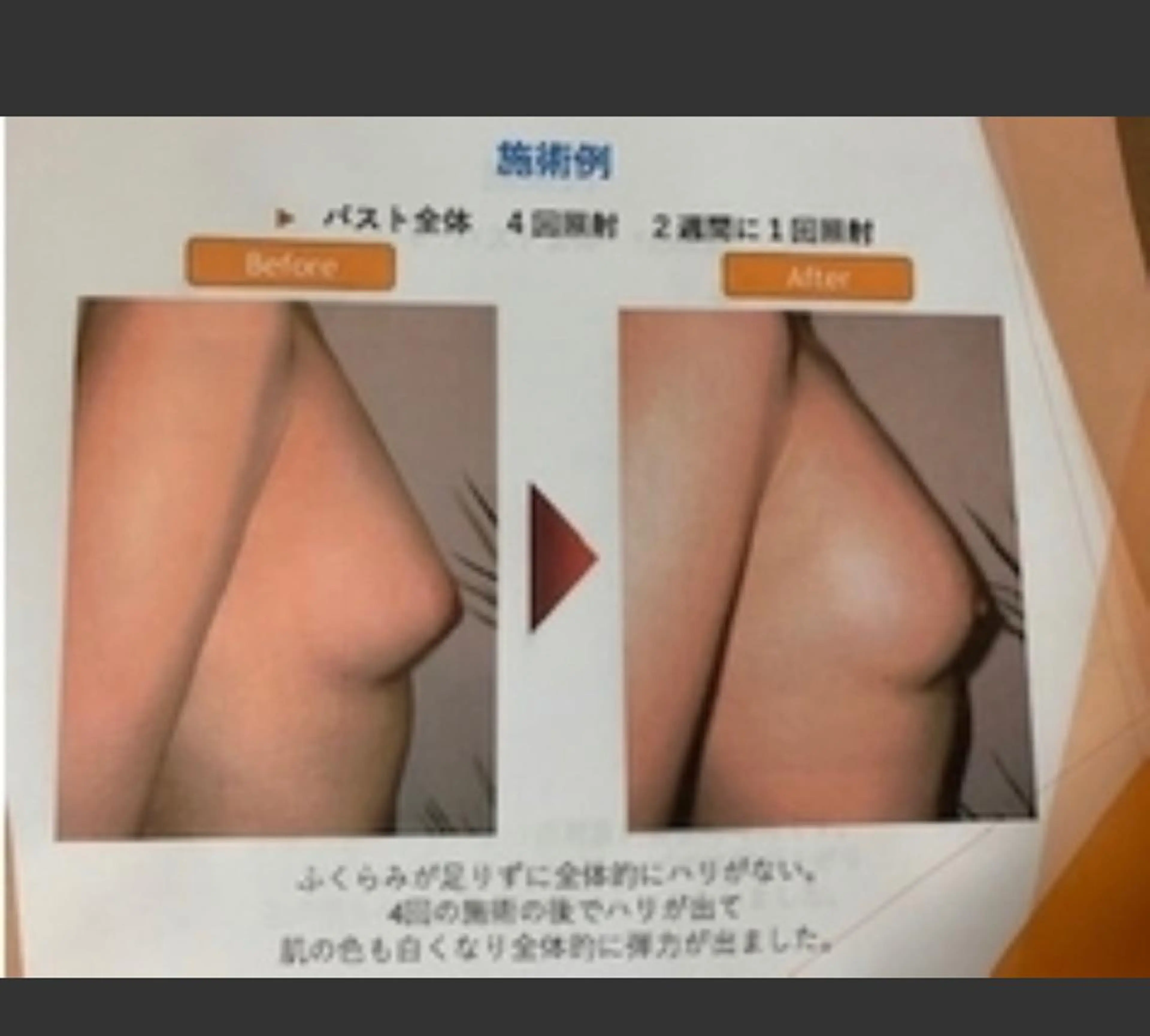 バストアップケア！　１～２カップ上がる♪の写真