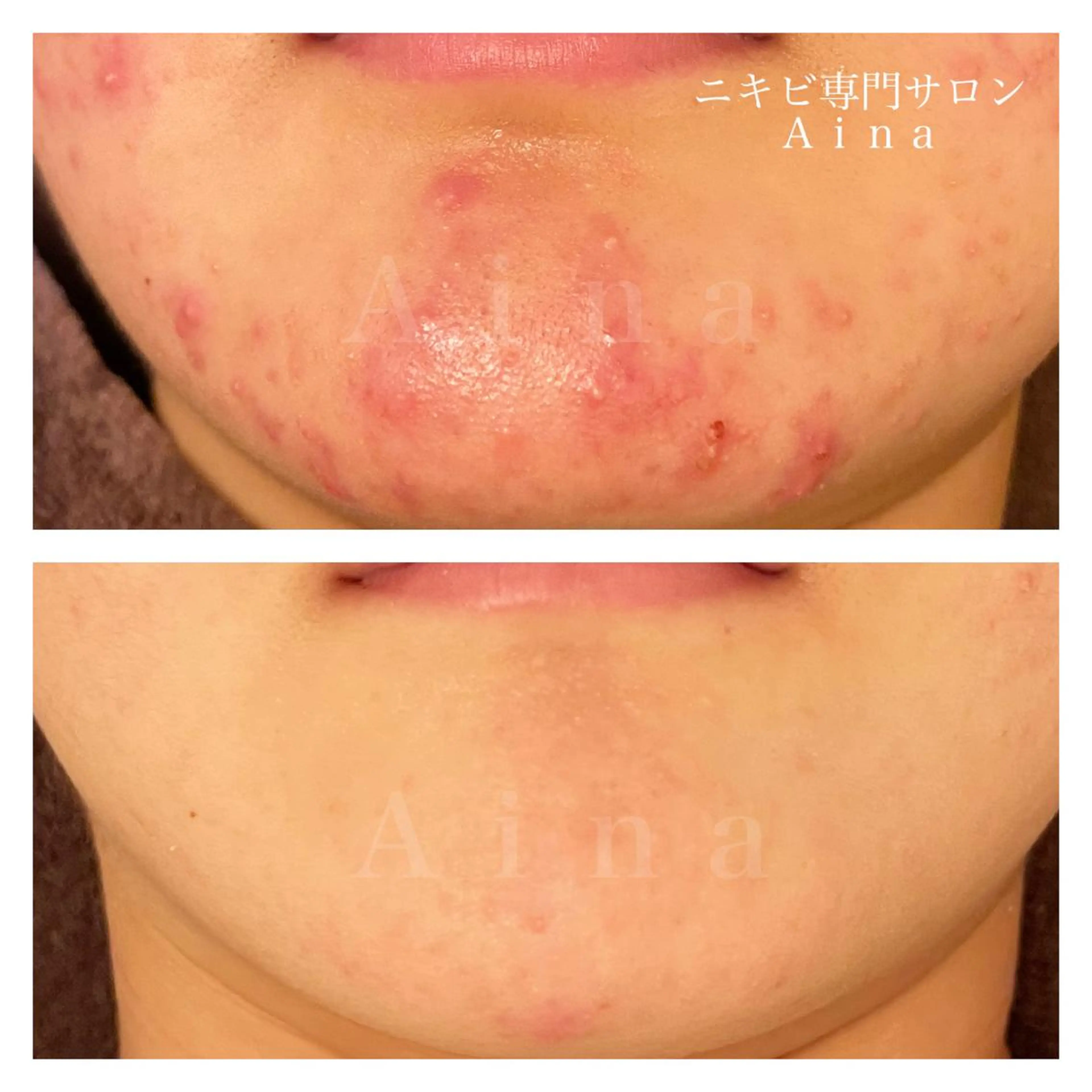 ショート パーマ ヘアアレンジ メンズ キッズ ネイル マツエク・マツパ アイブロウ エステ リラク ニキビ跡専門サロン Ａｉｎａのエステ・リラクイメージ