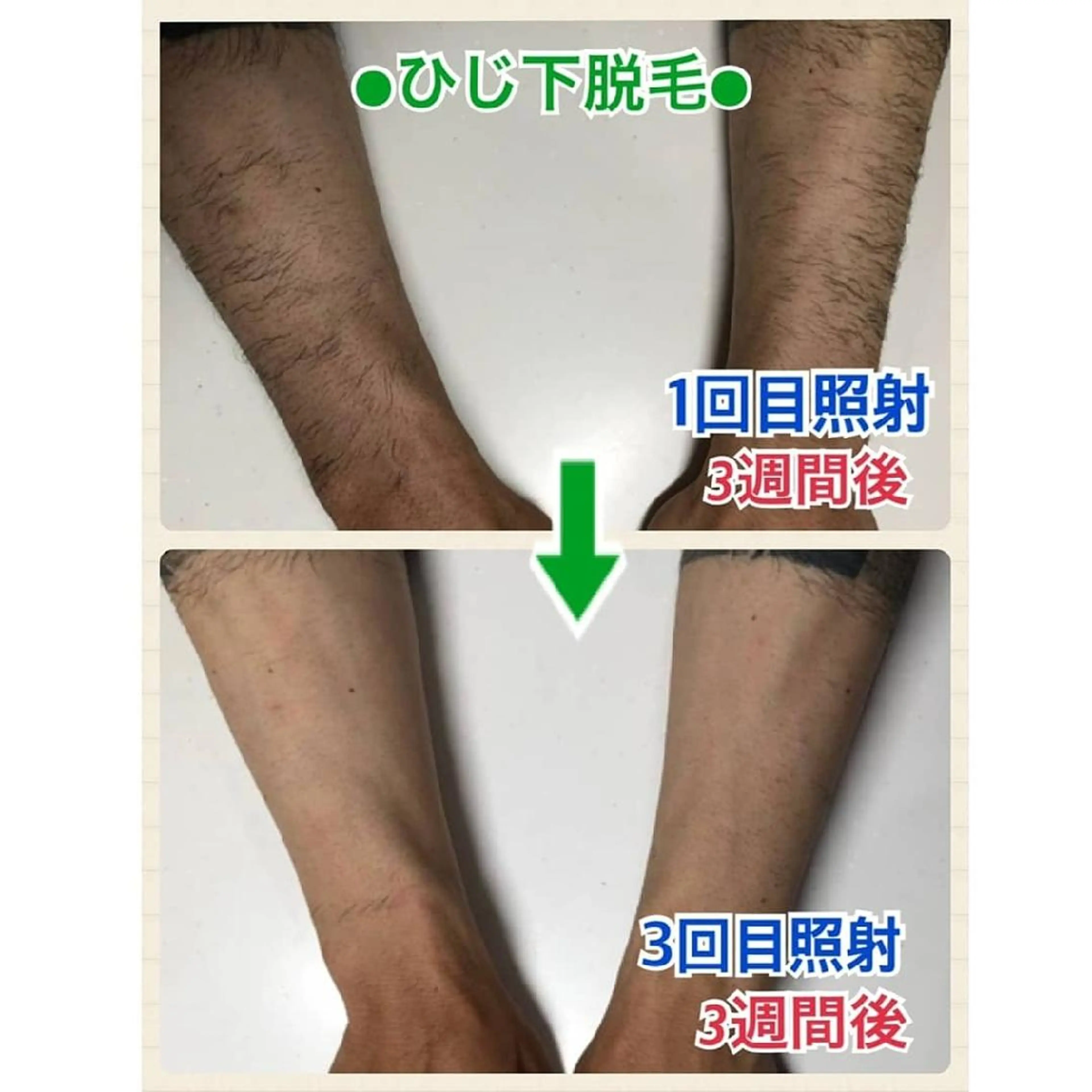 メンズ キッズ 脱毛 BiSTA ヒロのエステ・リラクイメージ