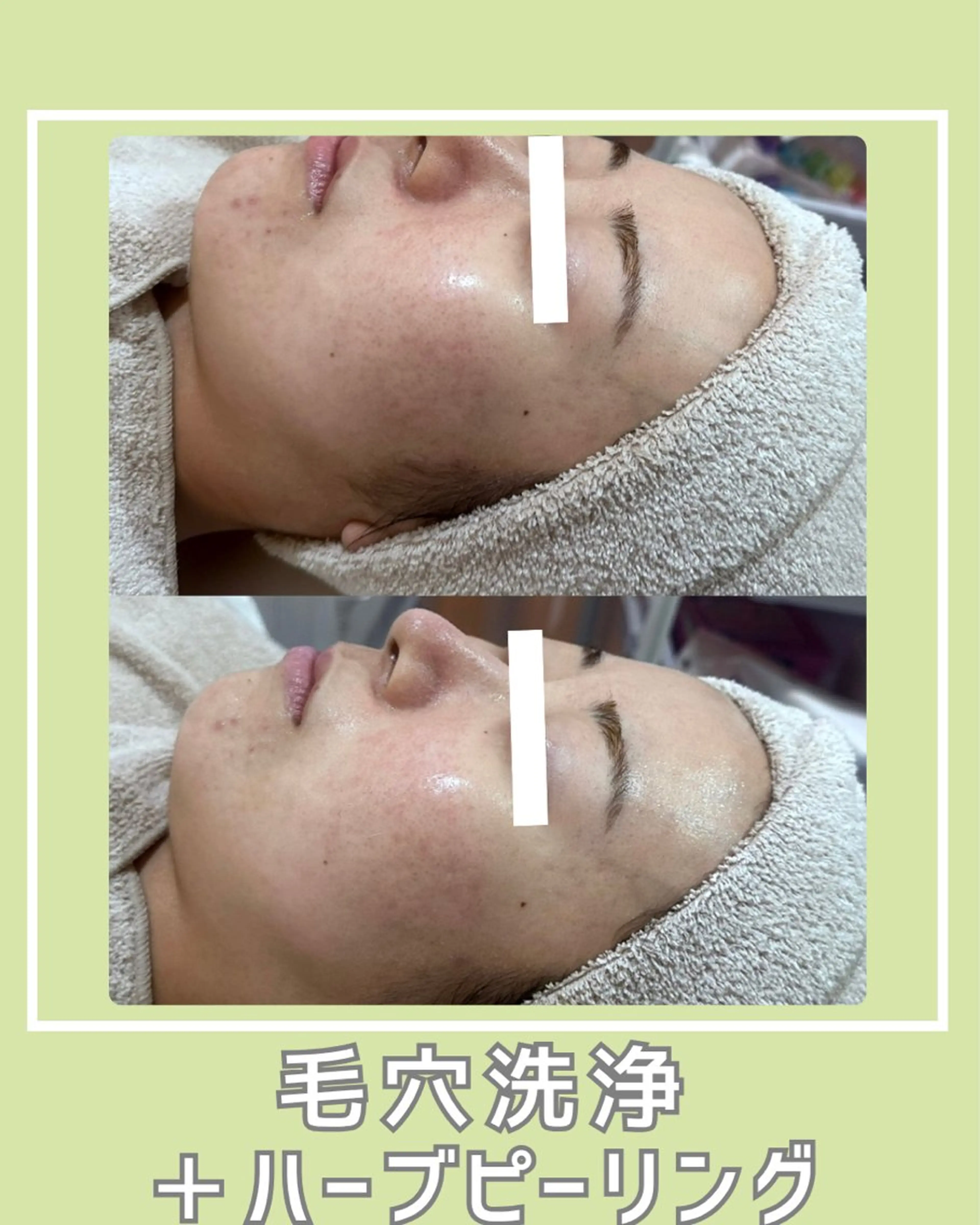 |ピーリング・毛穴| soina神楽坂のエステ・リラクイメージ