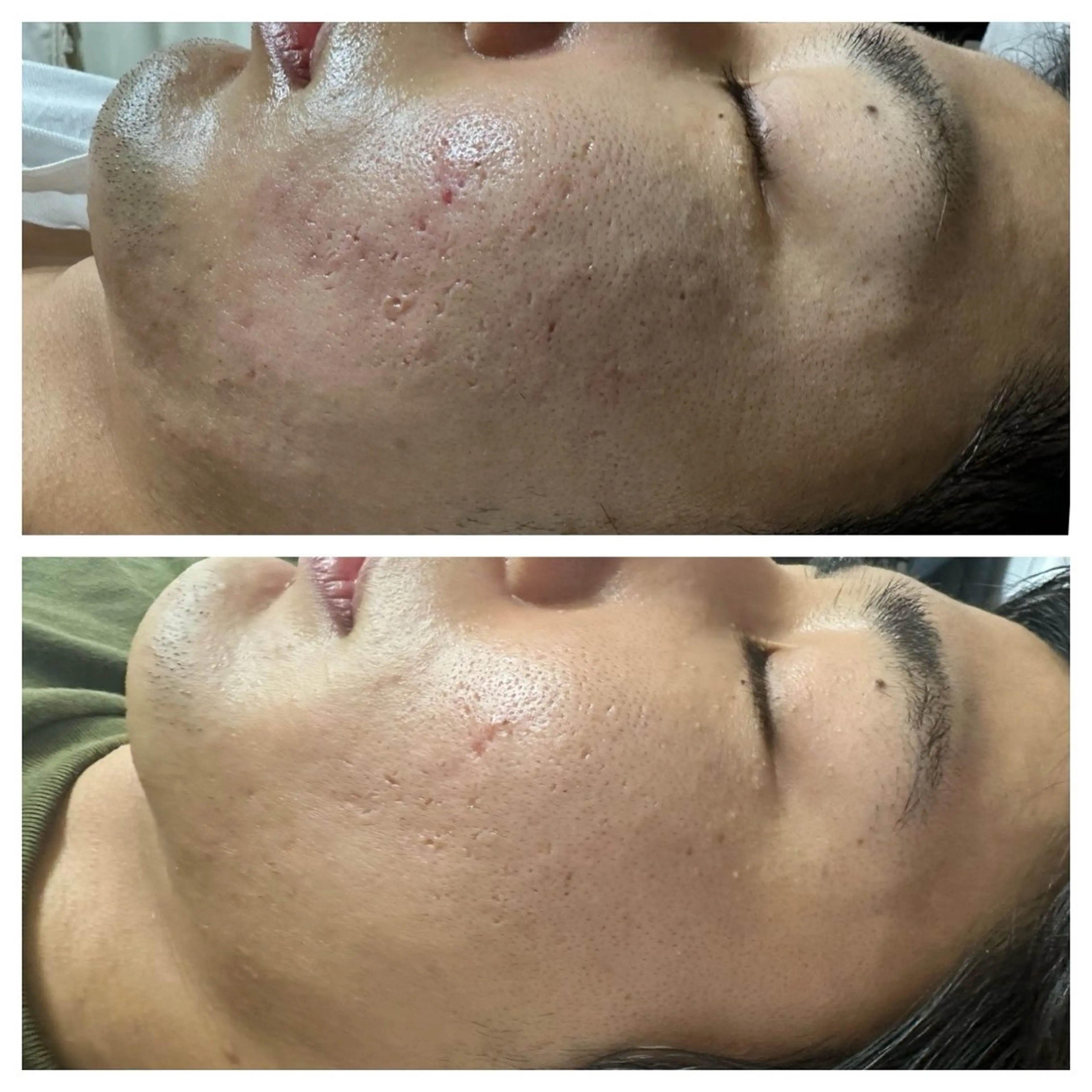 令和の虎で話題の針入りハーブピーリングボディ1箇所（毛穴／テカリ/ニキビ／肌荒れ／乾燥＞の写真