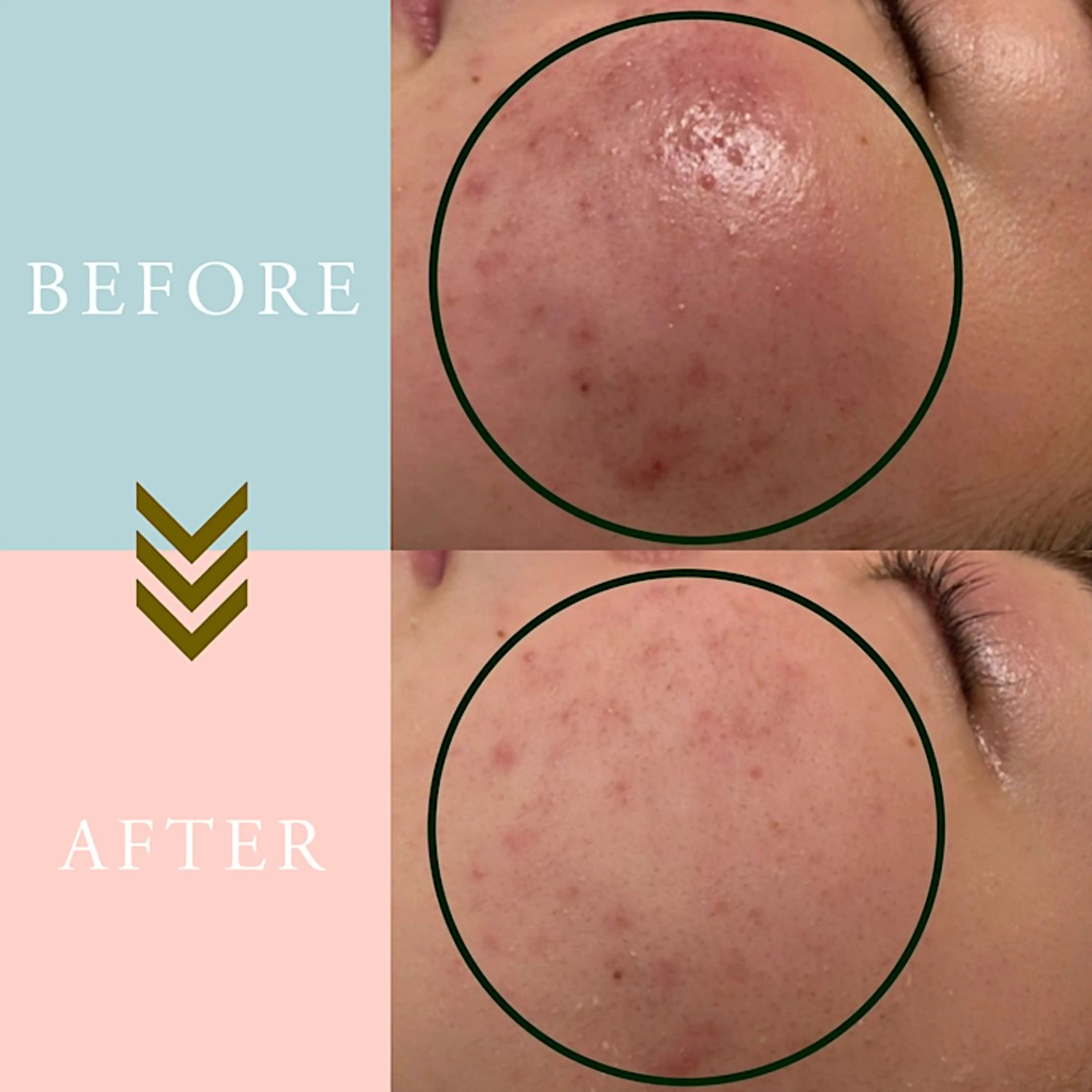 繰り返すニキビ・毛穴 ✨つくば肌質改善専門のエステ・リラクイメージ