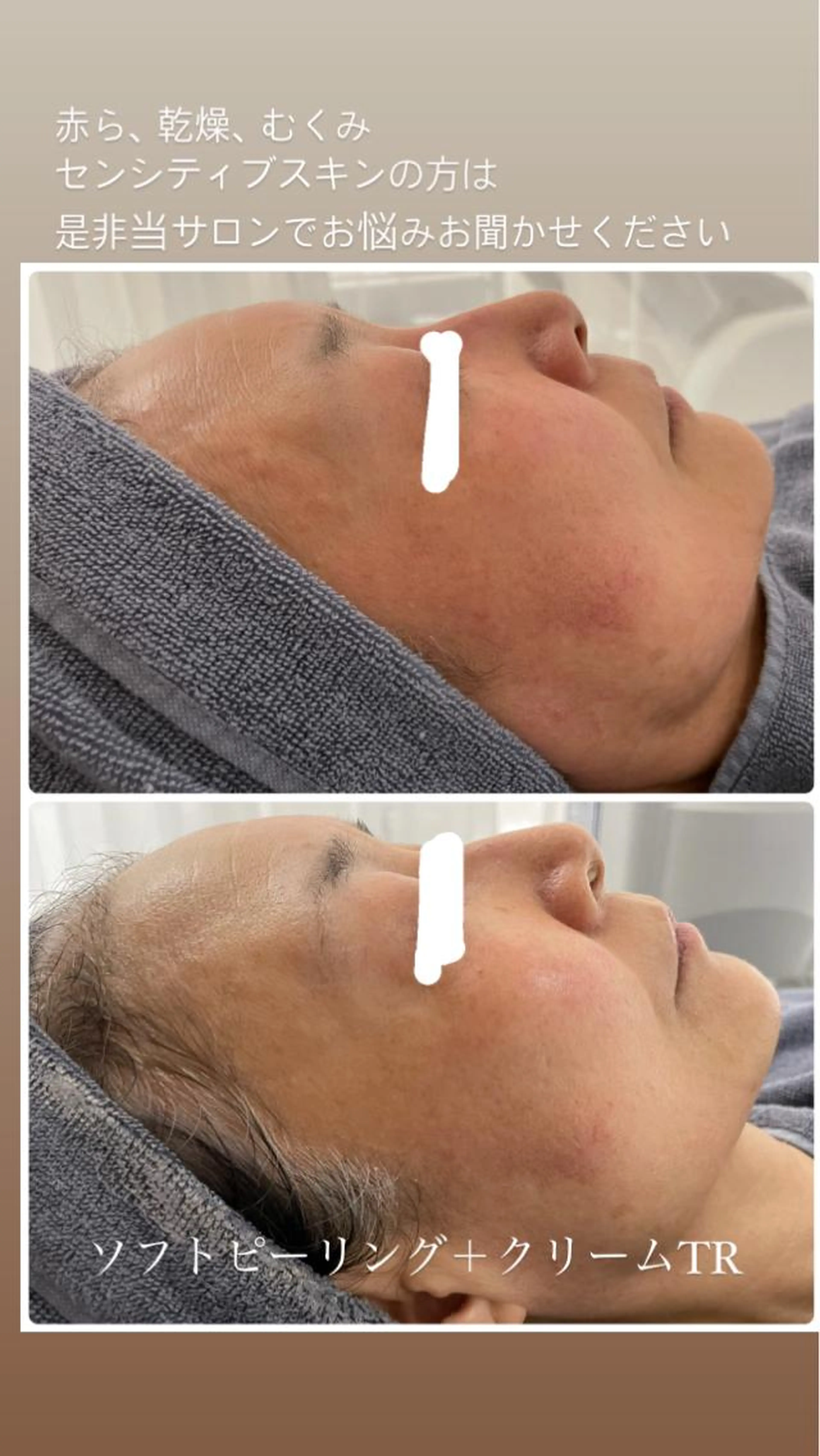 赤ら顔や乾燥肌が気になる方にオススメ！敏感肌さんの角質ケア♪の写真