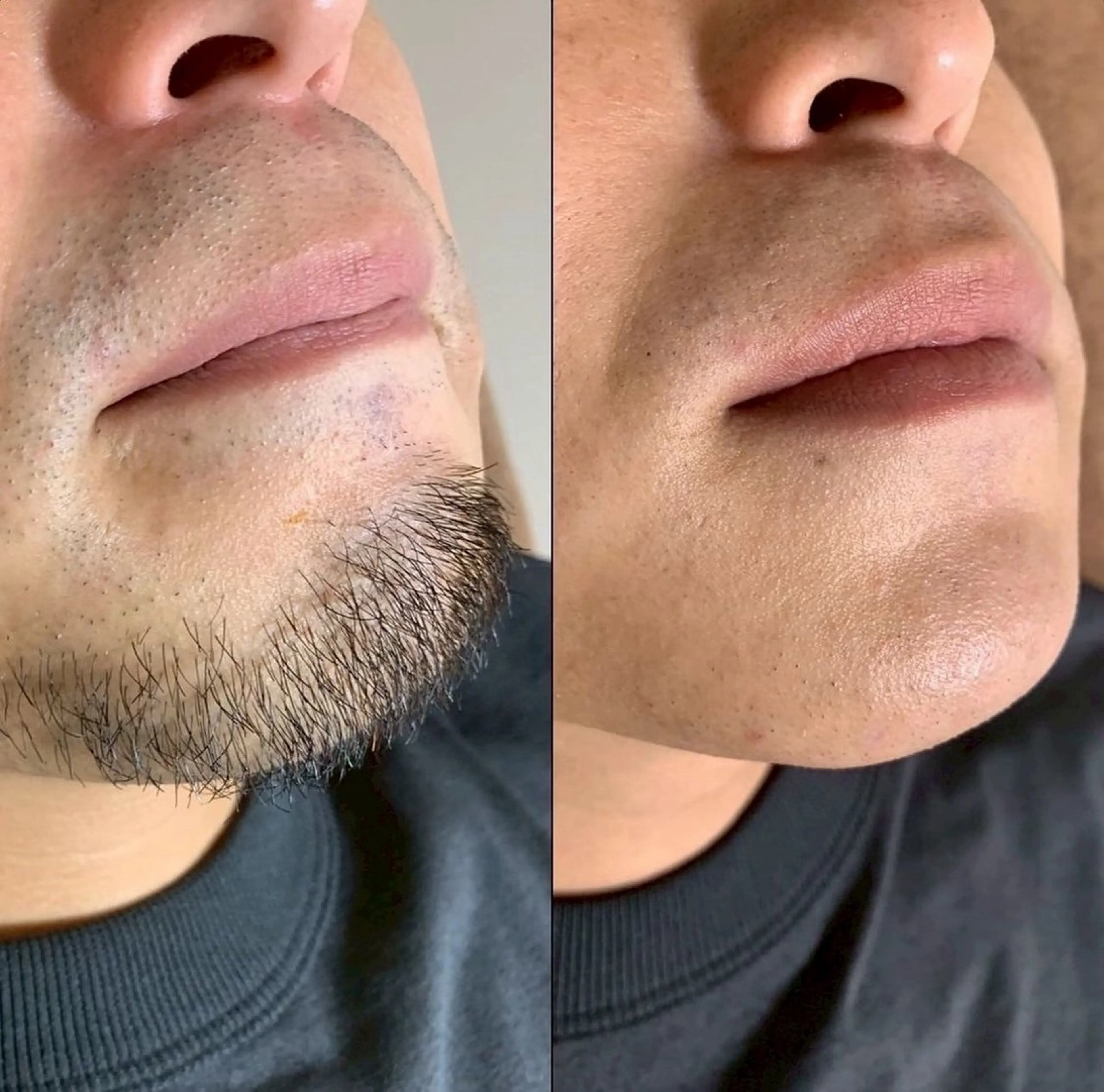 【メンズ】ヒゲ脱毛🧔‍♂️全顔照射　¥8,800→¥5,700✨　IPL脱毛✖️SHR脱毛のハイブリッドタイプ🌟の写真