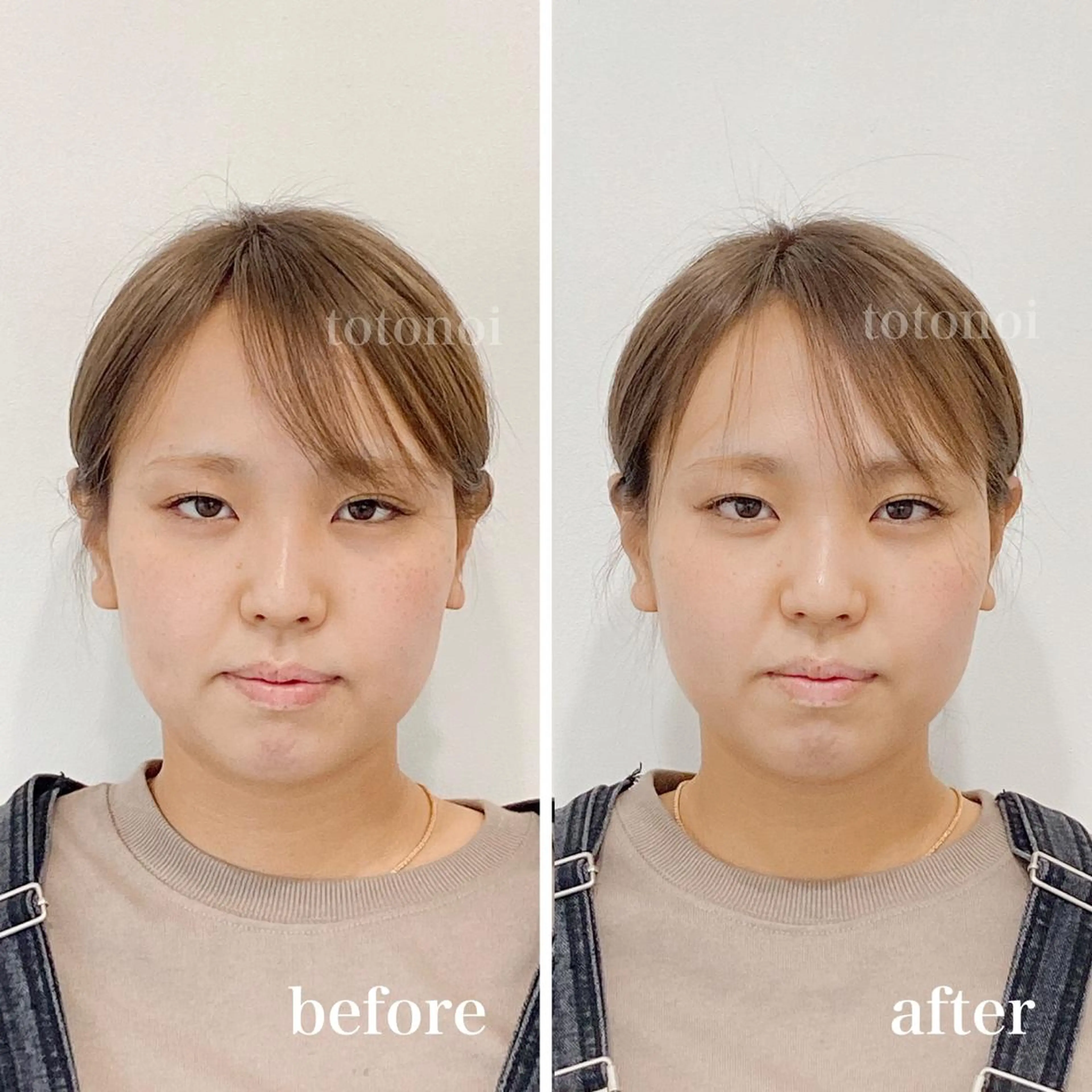 印象の良くなる 美容鍼のエステ・リラクイメージ