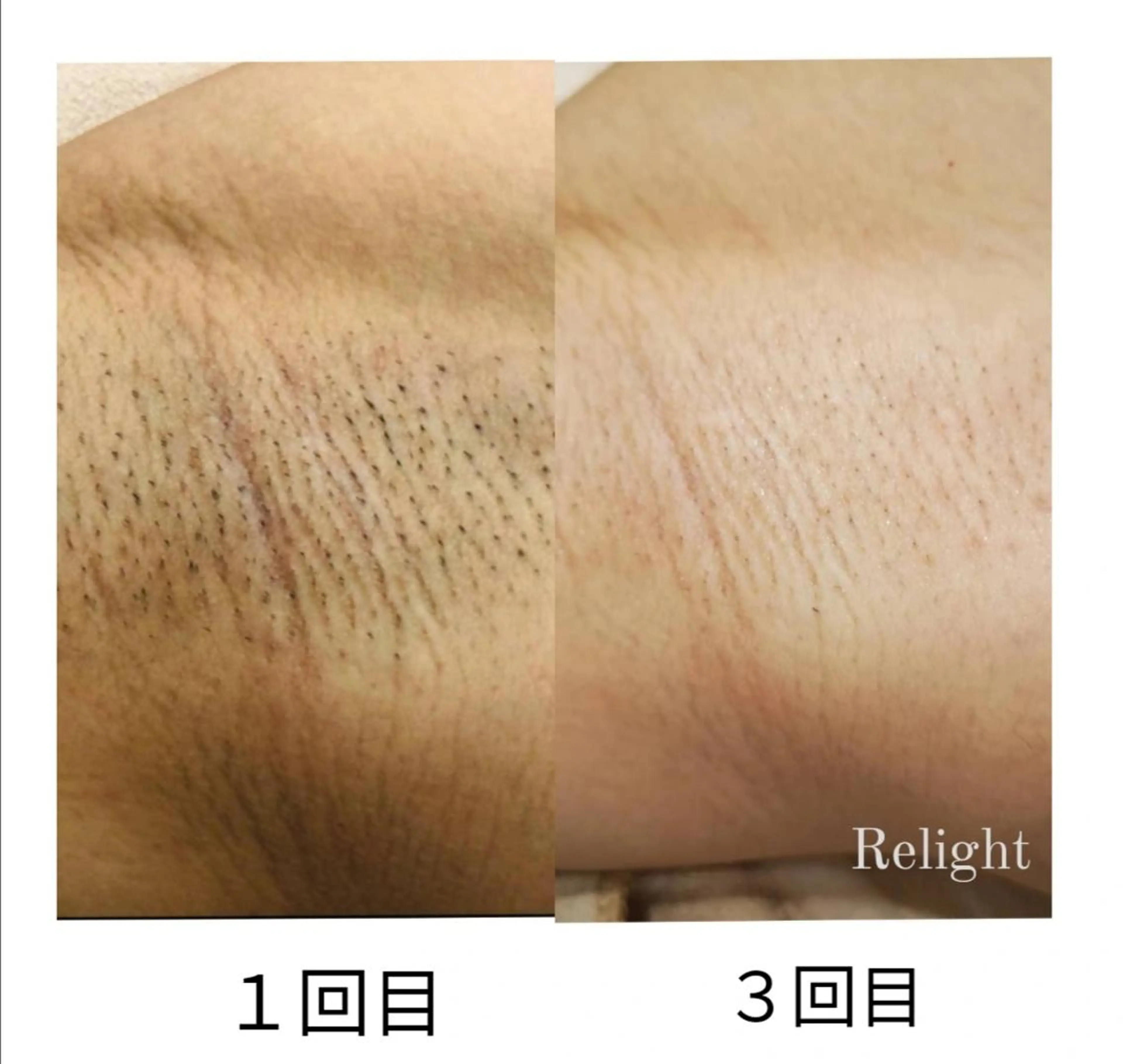 脱毛 Relight あかりのエステ・リラクイメージ