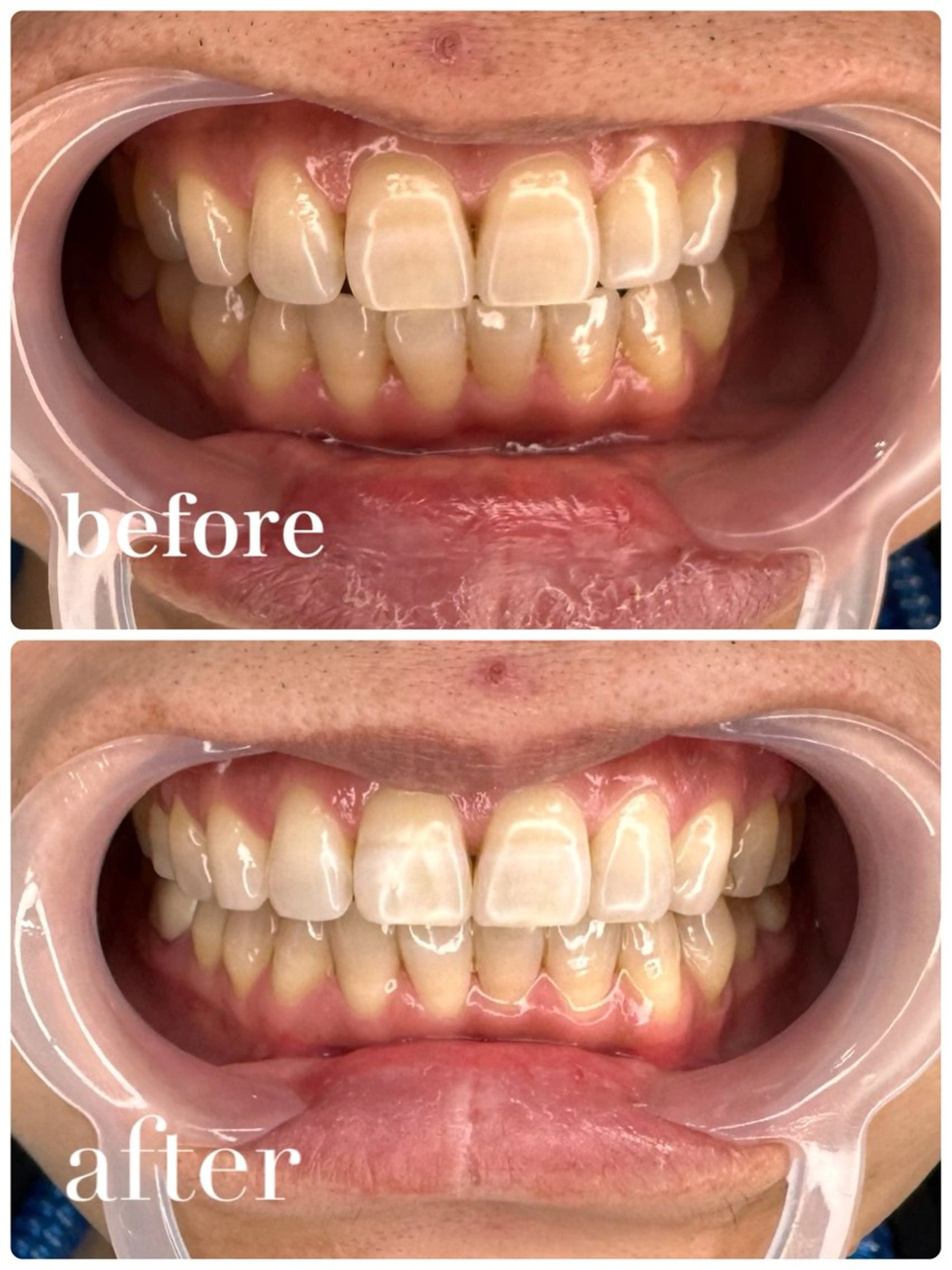 【4回券🎫】驚きの早さでトーンアップ！全8回照射(10分✖️2照射の4回分)🦷ハイパワーセルフホワイトニング✨の写真