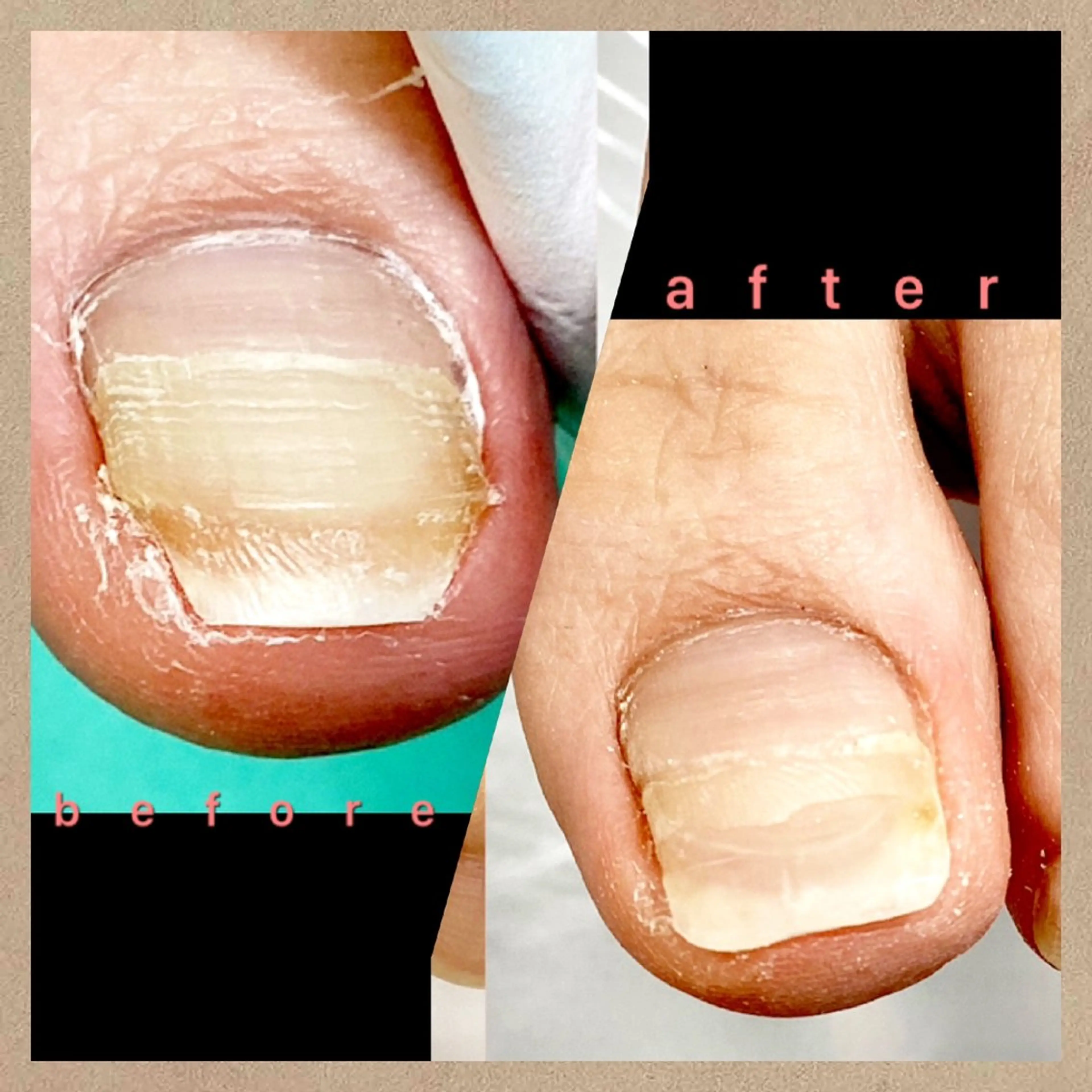 その他(ネイル) 巻き爪補正店 大阪なんば店のネイルデザイン