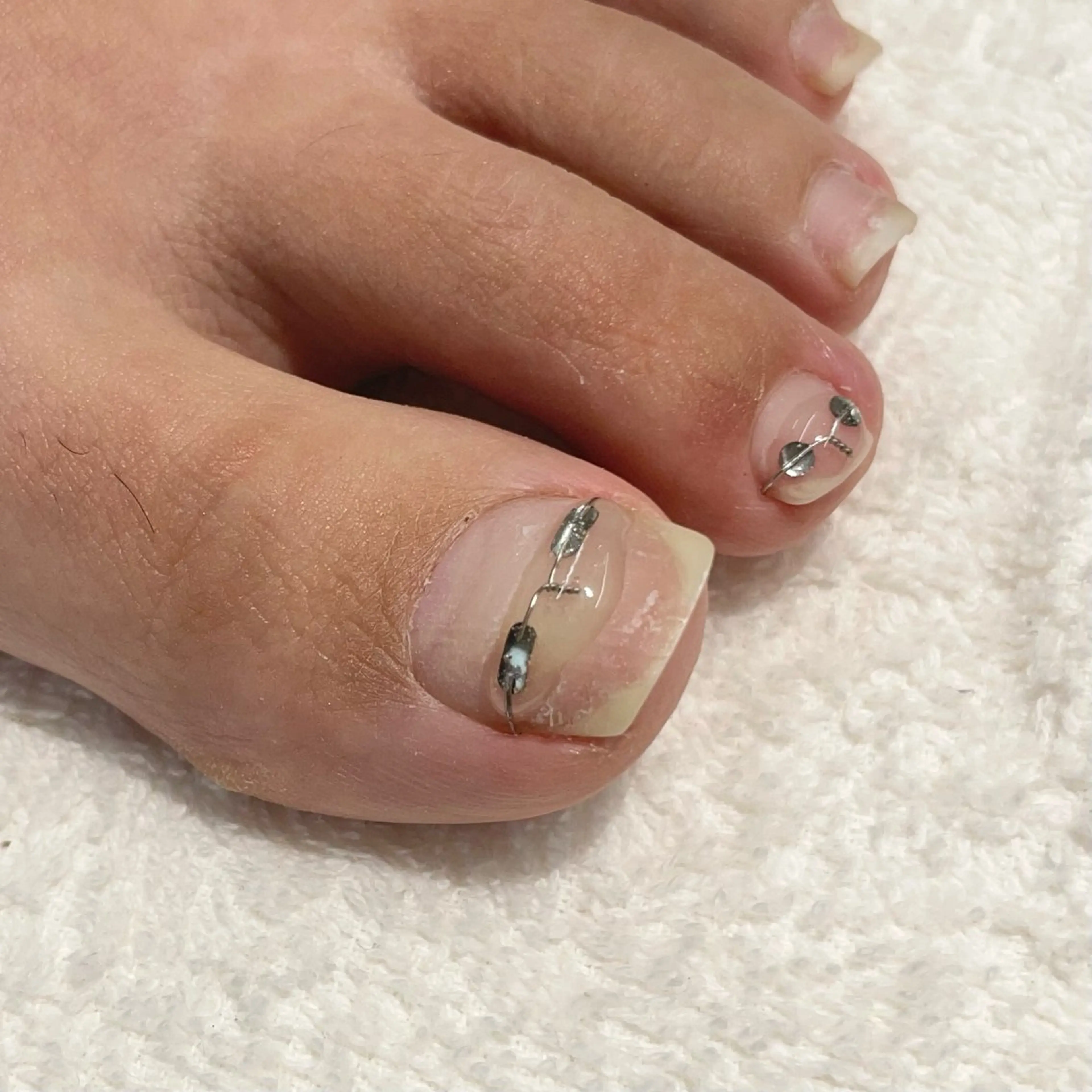 巻き爪ケア/巻き爪調整/巻き爪緩和(アペルタ)1本の写真