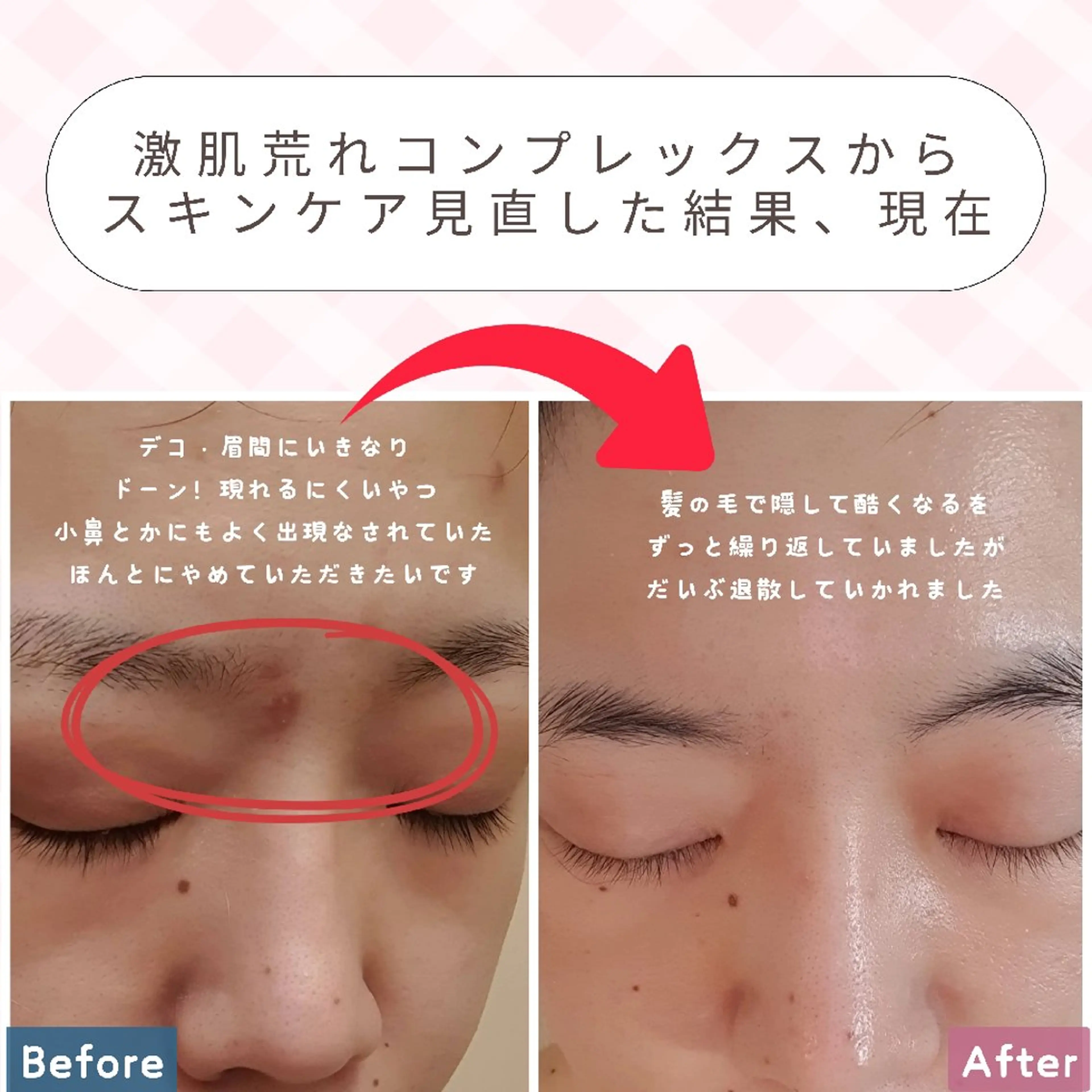 痩身ハーブピーリング 筋膜リリース☆B&Hのエステ・リラクイメージ