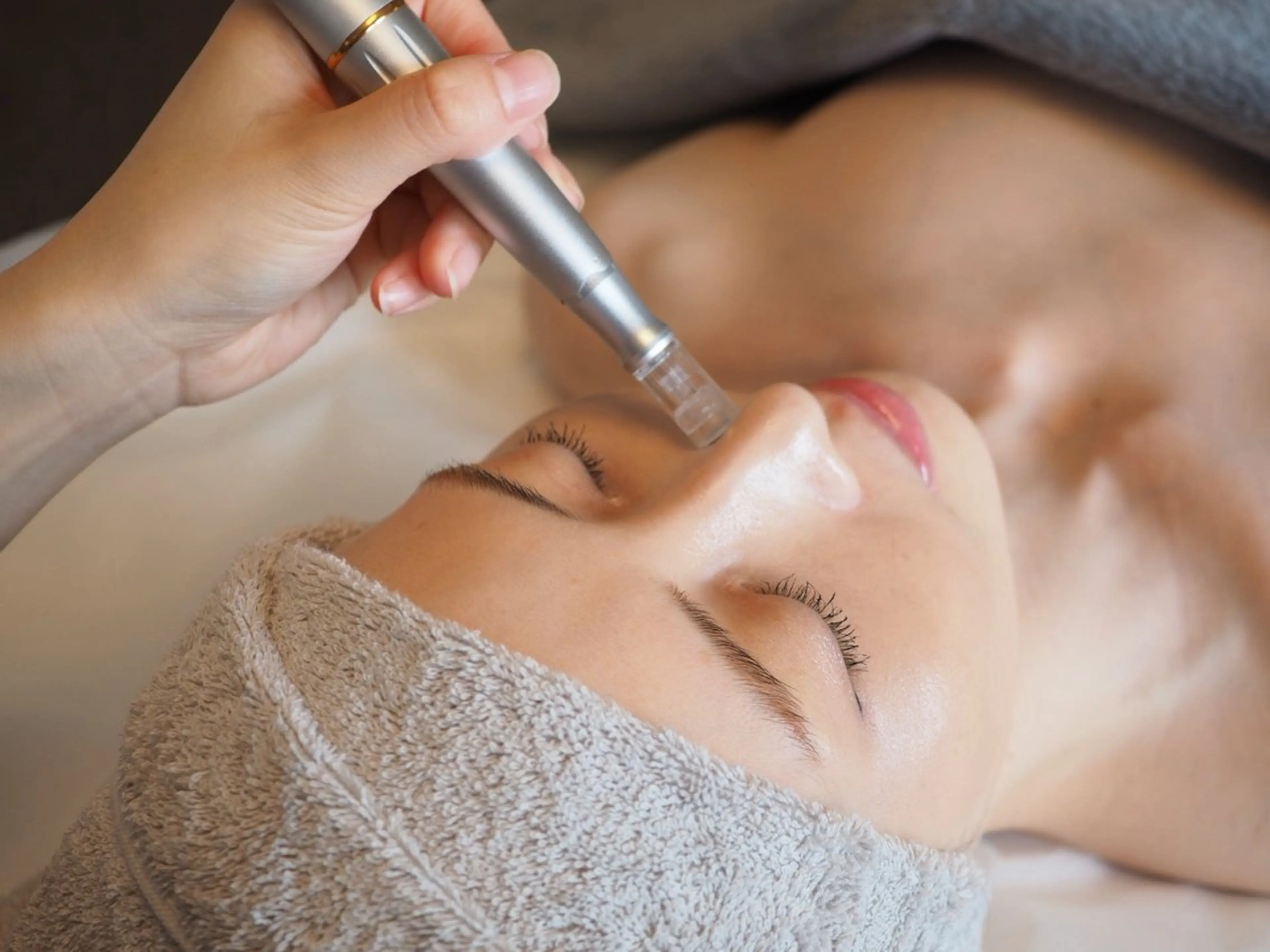 【ニキビ跡にはコレ！】剥離なしハーブピーリング+ダーマペン+高濃度ビタミンパックの写真