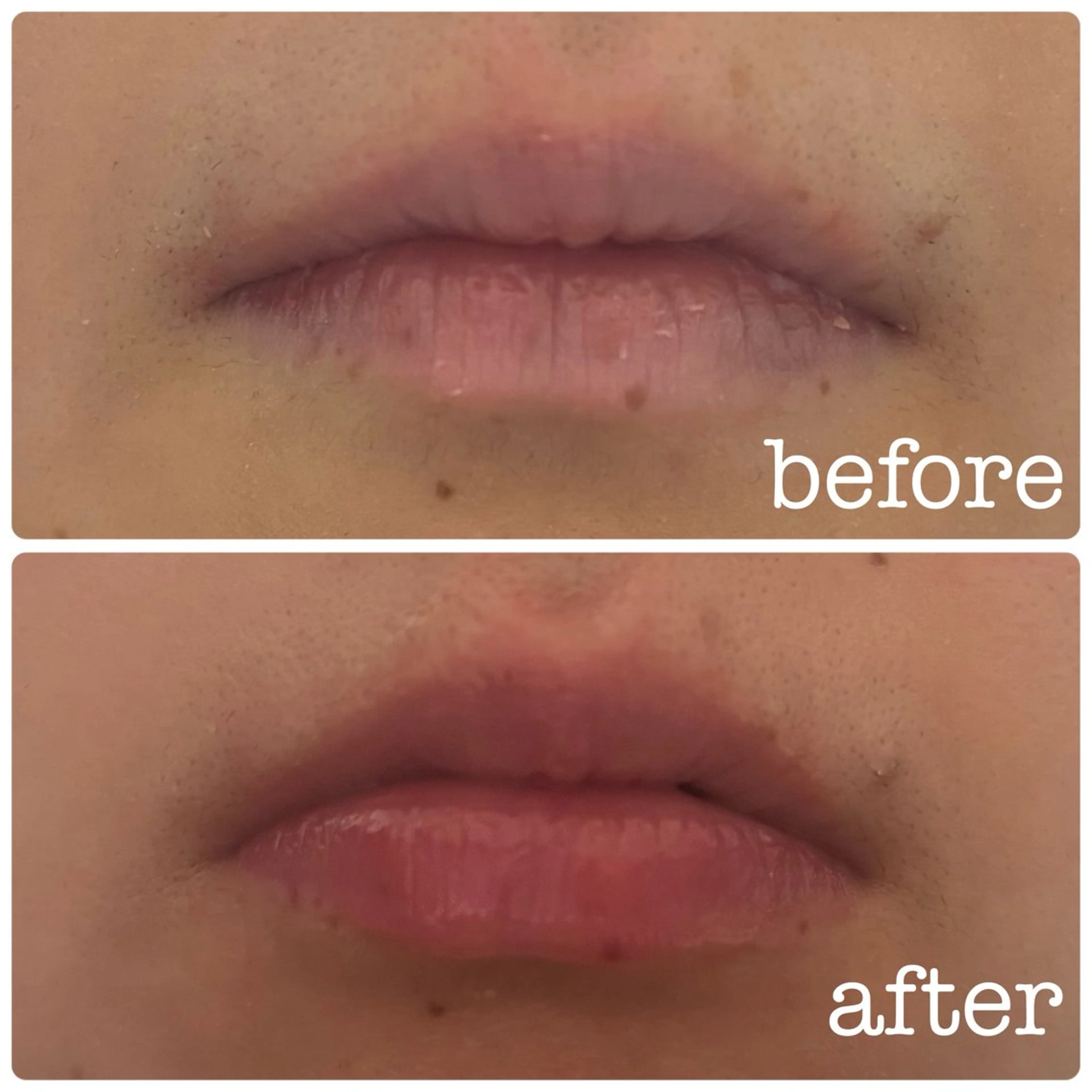 【エステ】リップエステ👄の写真