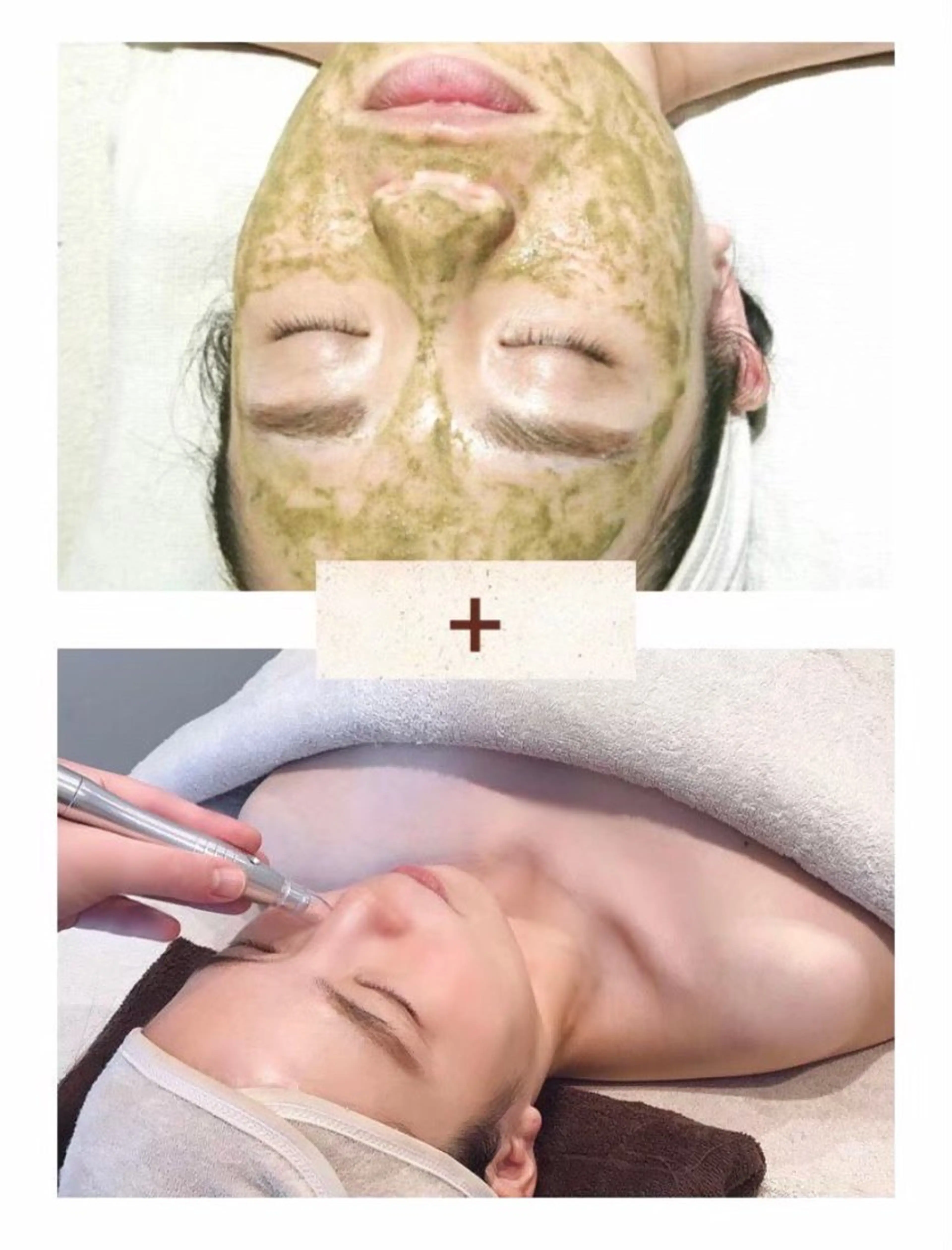 【ハーブピーリング+毛穴吸引】毛穴レス美肌✨(毛穴/ニキビ/ザラつき/シミ/シワ)の写真