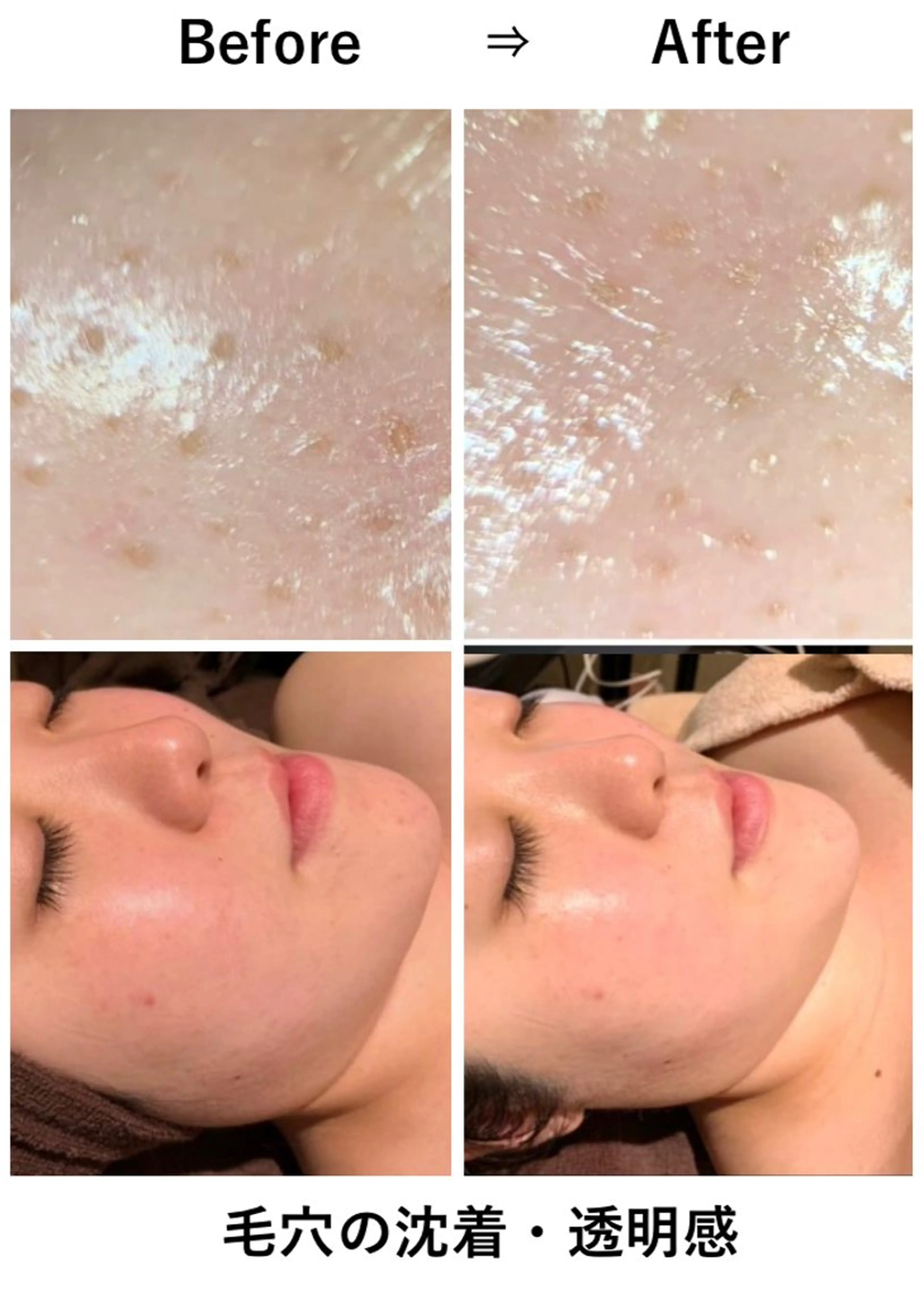 当店1番人気✨新世代ピーリング"バイオピール®"どんな肌質でも施術可能💆🏻‍♀️✨顔脱毛+まつげmenu付き💗の写真