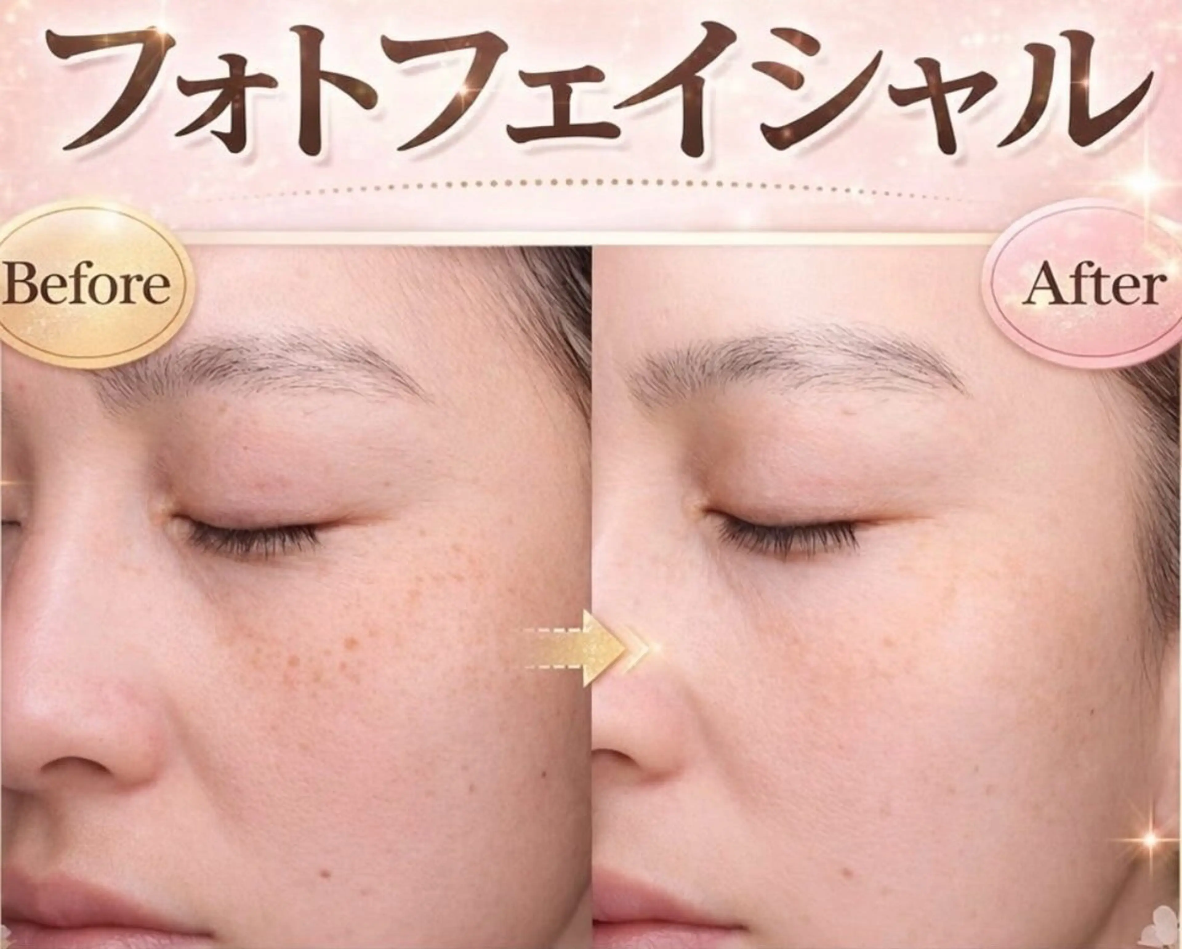 シミケア・美白【フォト光+シェービング+保湿うるつやパック付★】¥4980の写真