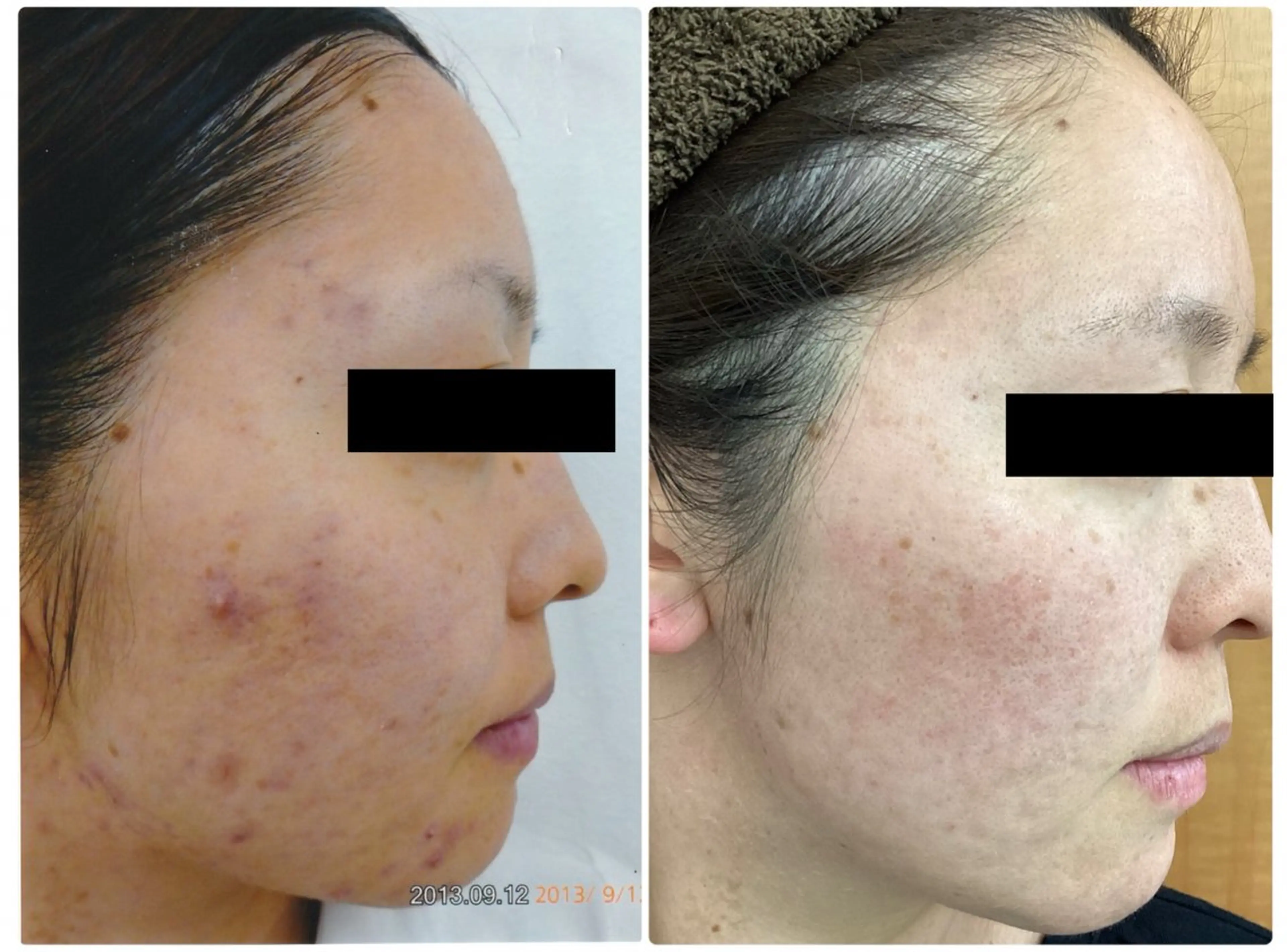 【学割】ニキビケア3回プログラムの写真