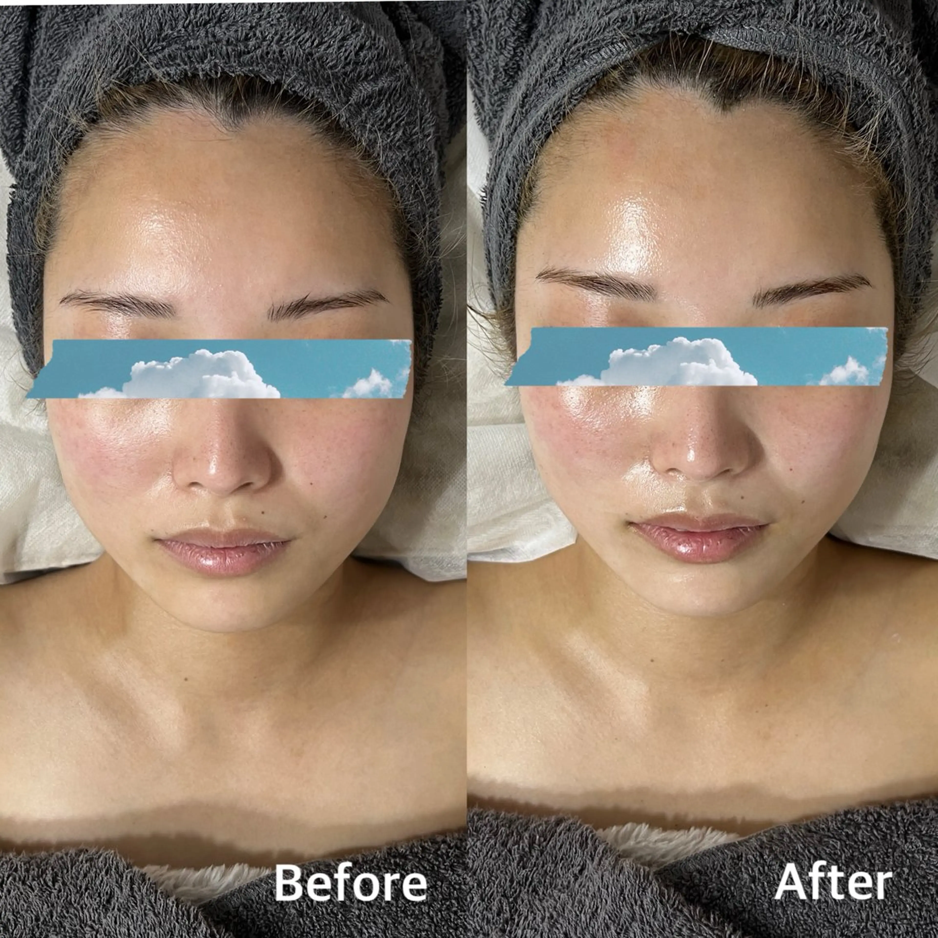 【毛穴・くすみ・乾燥まとめてケア】REVIハーブピーリング🌿陶肌トリートメント＋エンザイム1g＋VCF0.8mlの写真