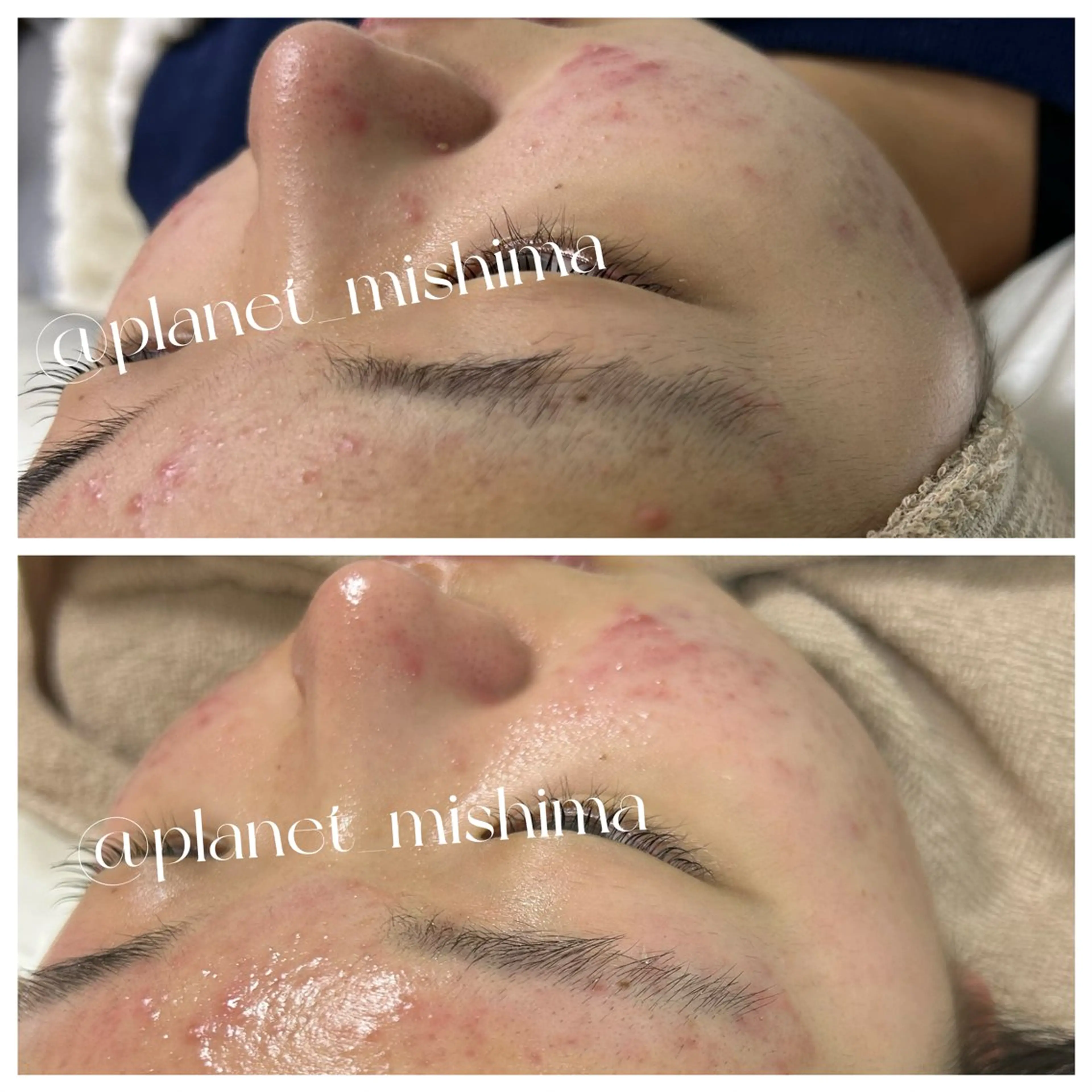 脱毛 Planet所属・Planet 三島のエステ・リラクイメージ