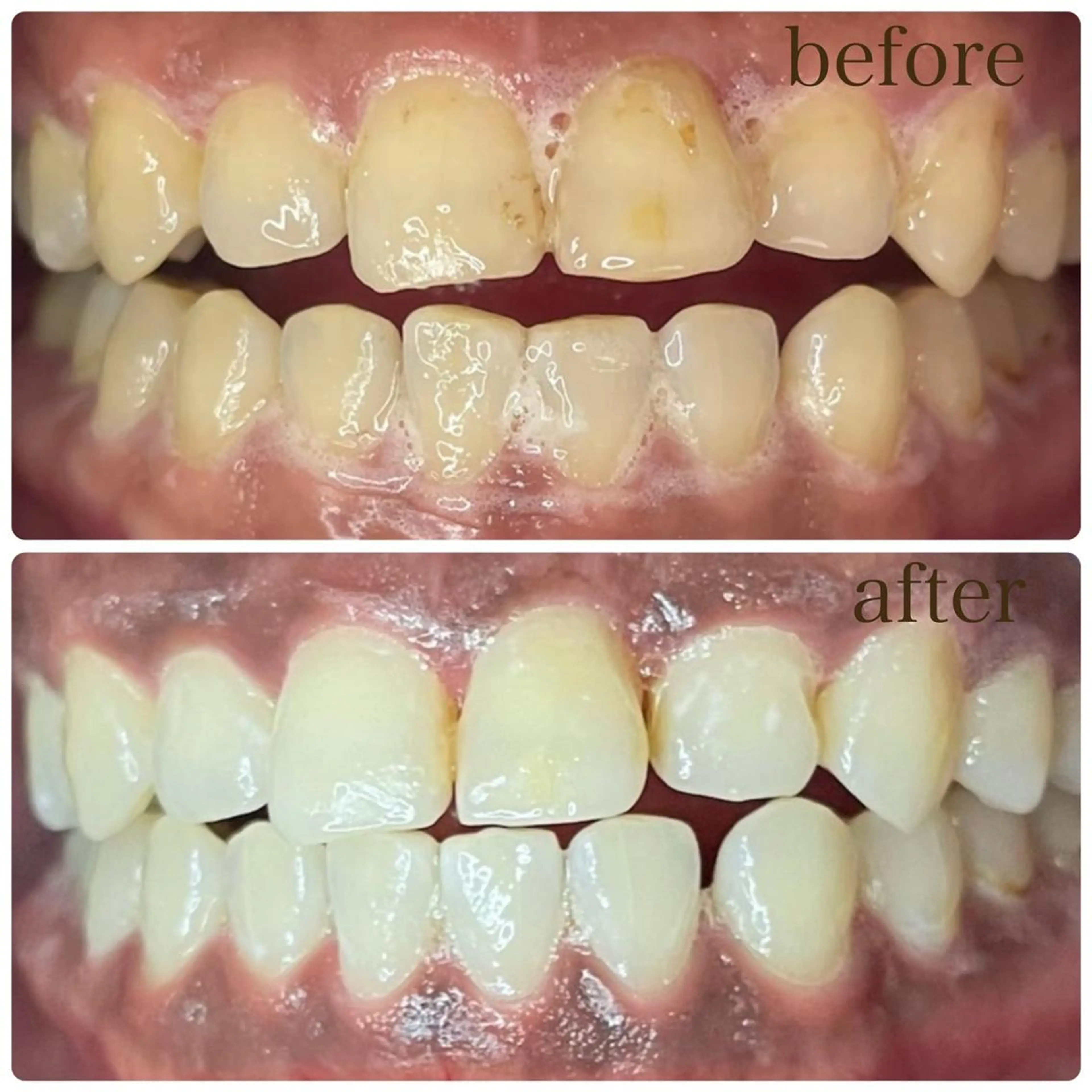 💐初めてのセルフホワイトニング💐 【平日12時~16時1日1名様限定】歯科提携💫ご新規様2照射1980円の写真