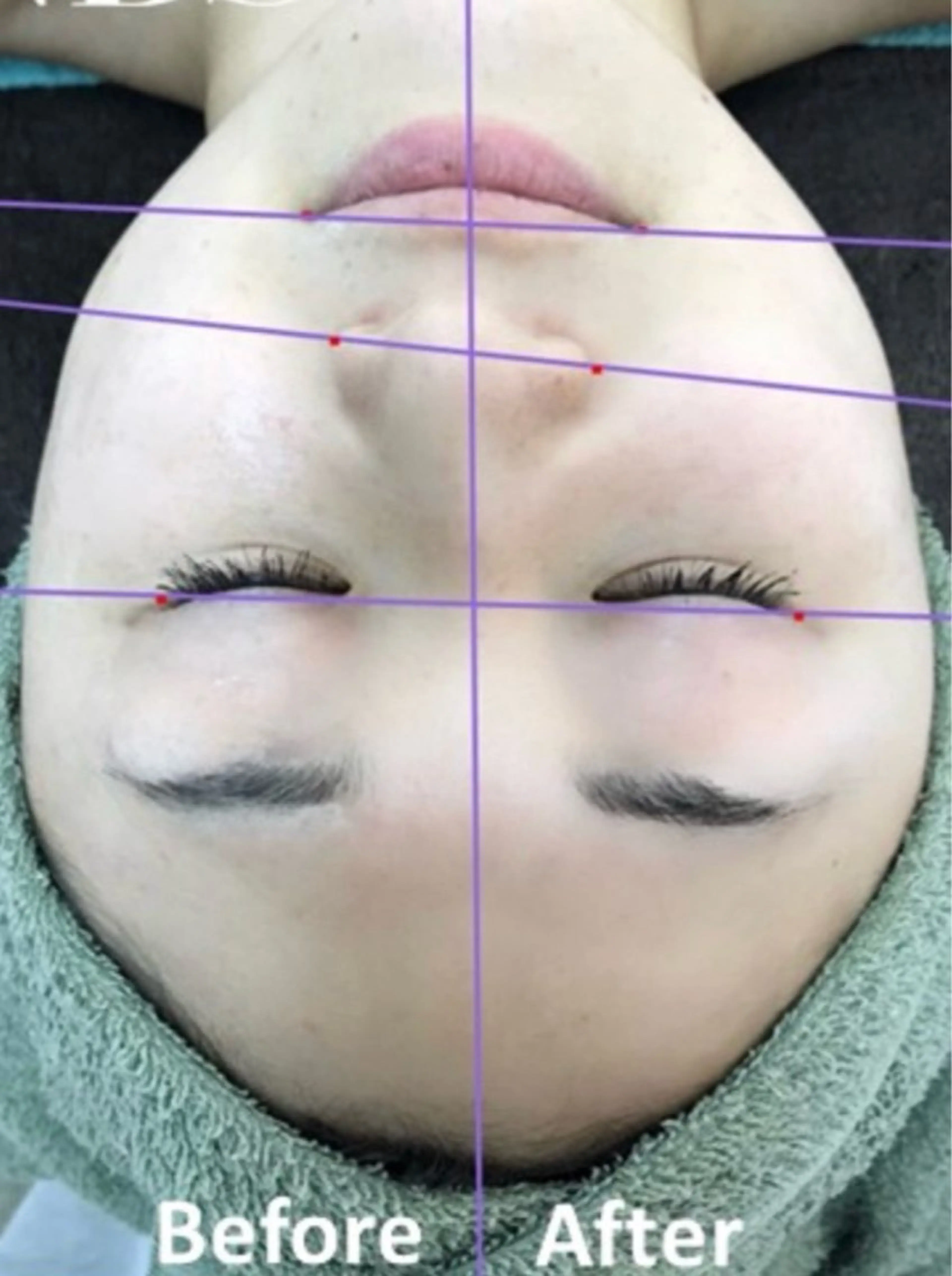 光フェイシャルの写真