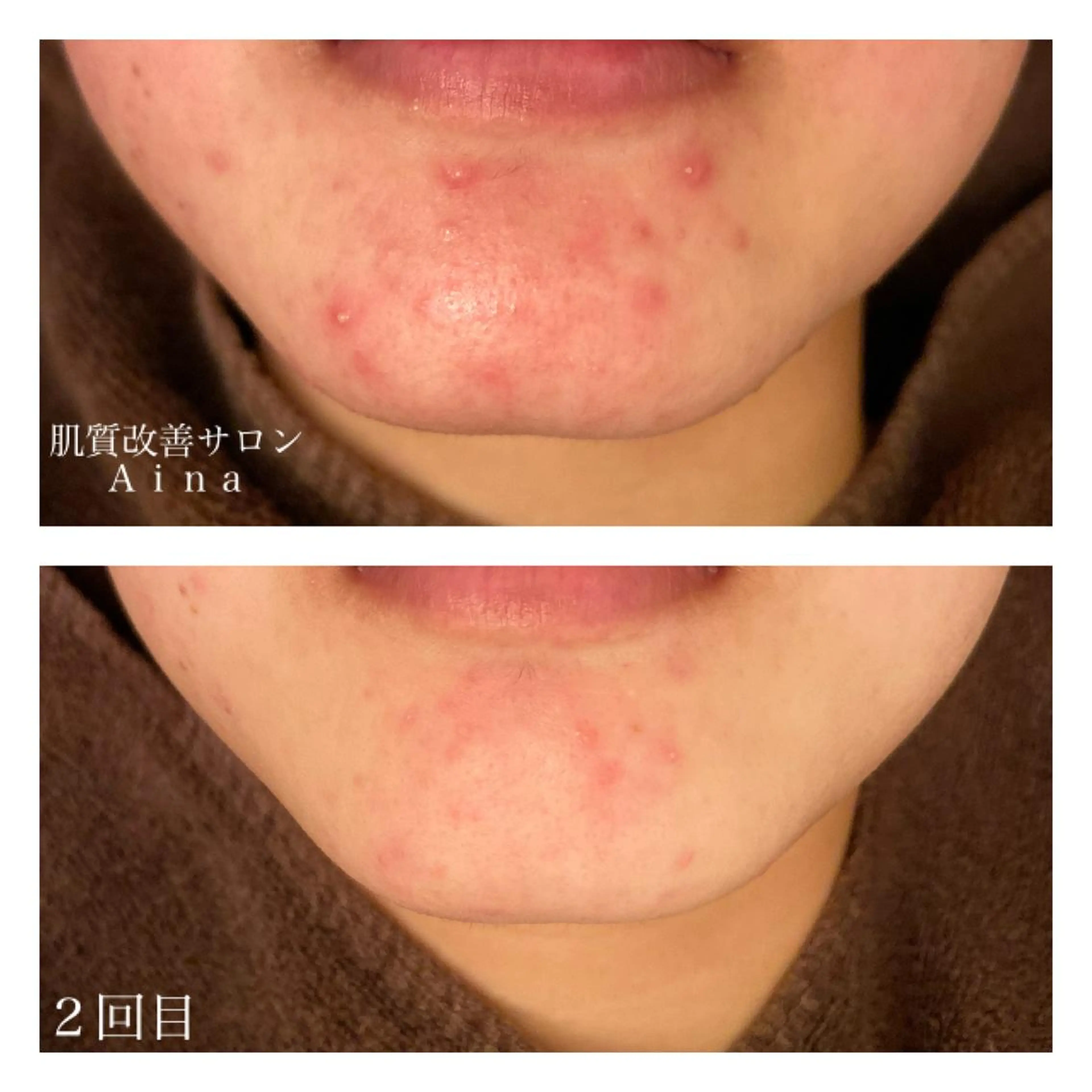 ショート カラー パーマ ヘアアレンジ メンズ キッズ ネイル マツエク・マツパ 赤色 ニキビ跡専門サロン Ａｉｎａのエステ・リラクイメージ