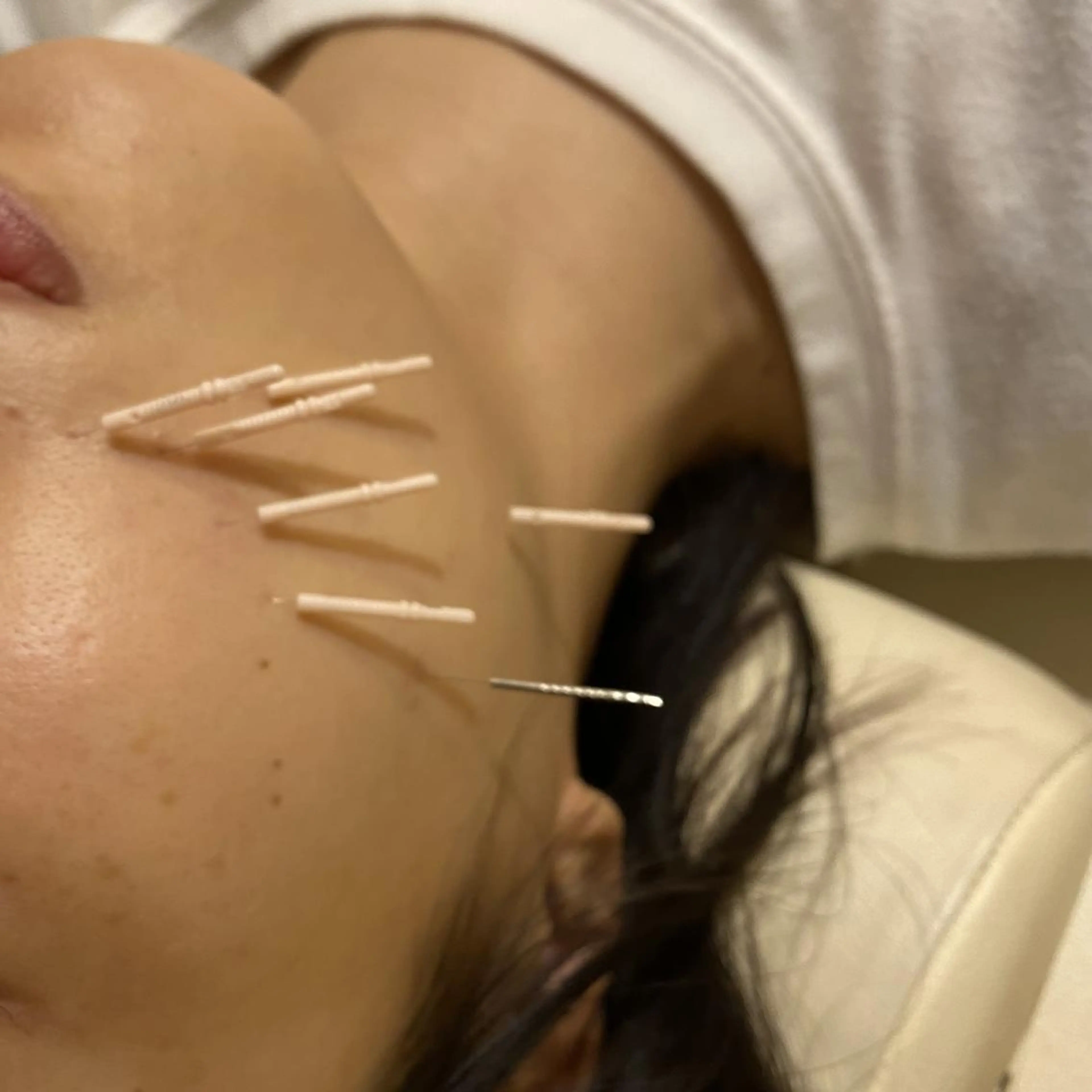 むくみたるみ専門☆ 美容鍼・小顔矯正のエステ・リラクイメージ