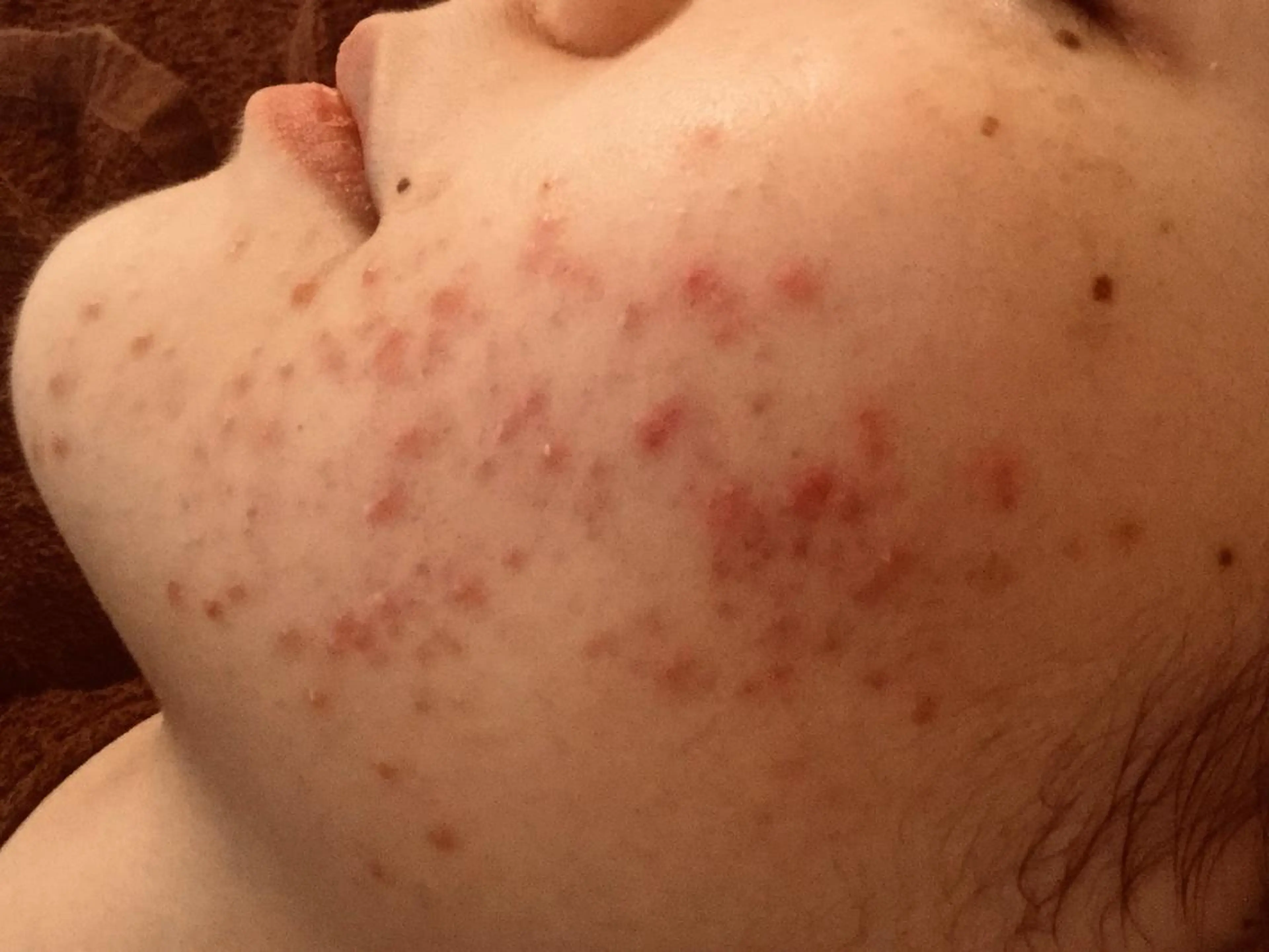 エステ リラク ニキビ/肌質改善専門 Snow skinのエステ・リラクイメージ