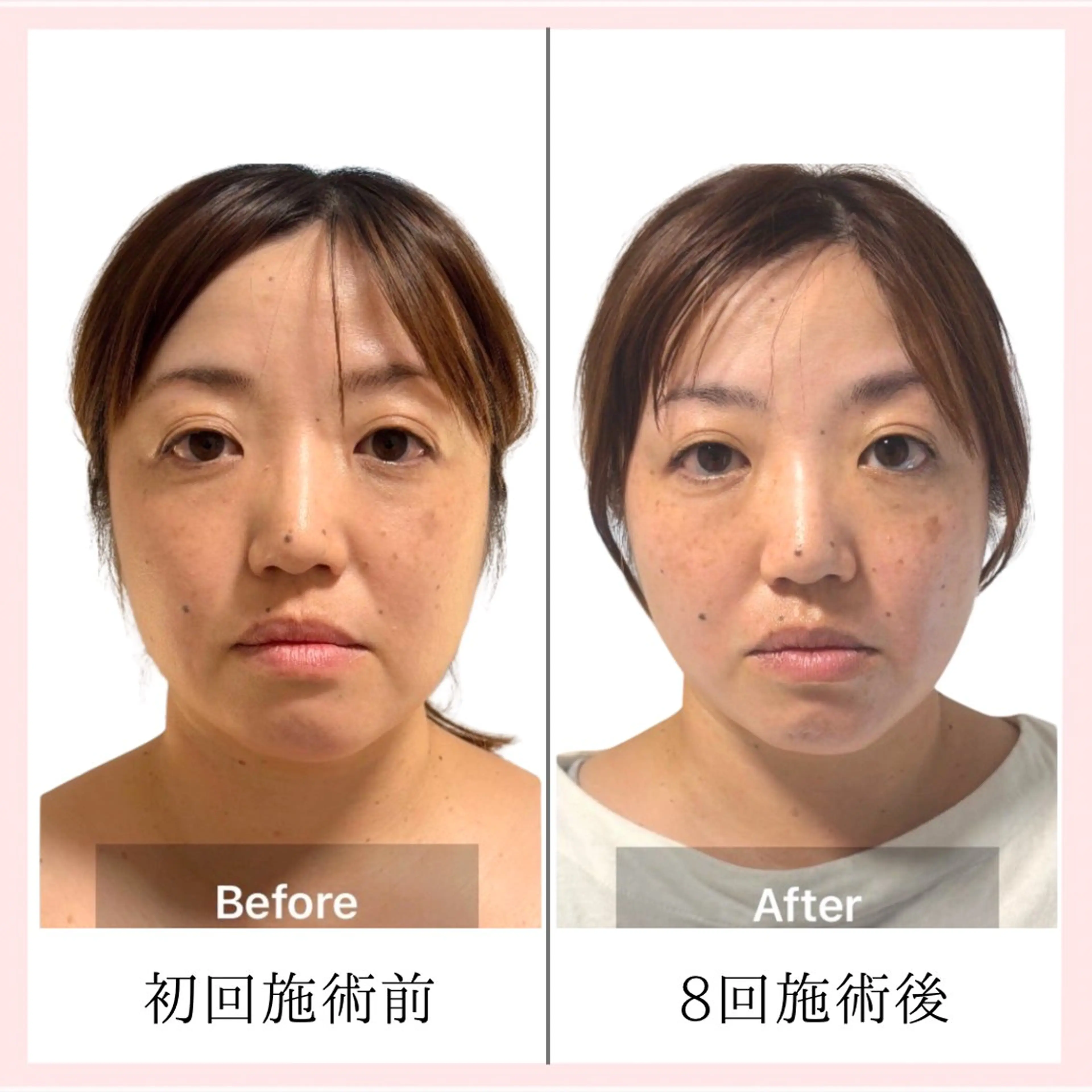 【小顔・たるみケア集中プログラム】60分×8回の写真